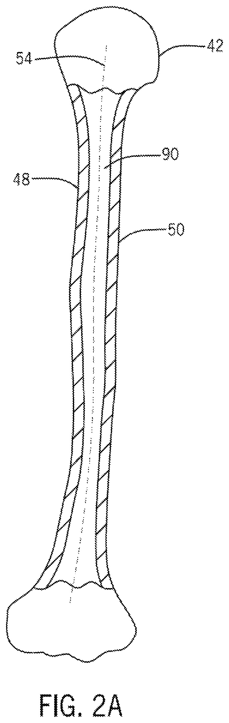 Patent US12496134 Figure 3 – Method for optimization of orthopedic component design