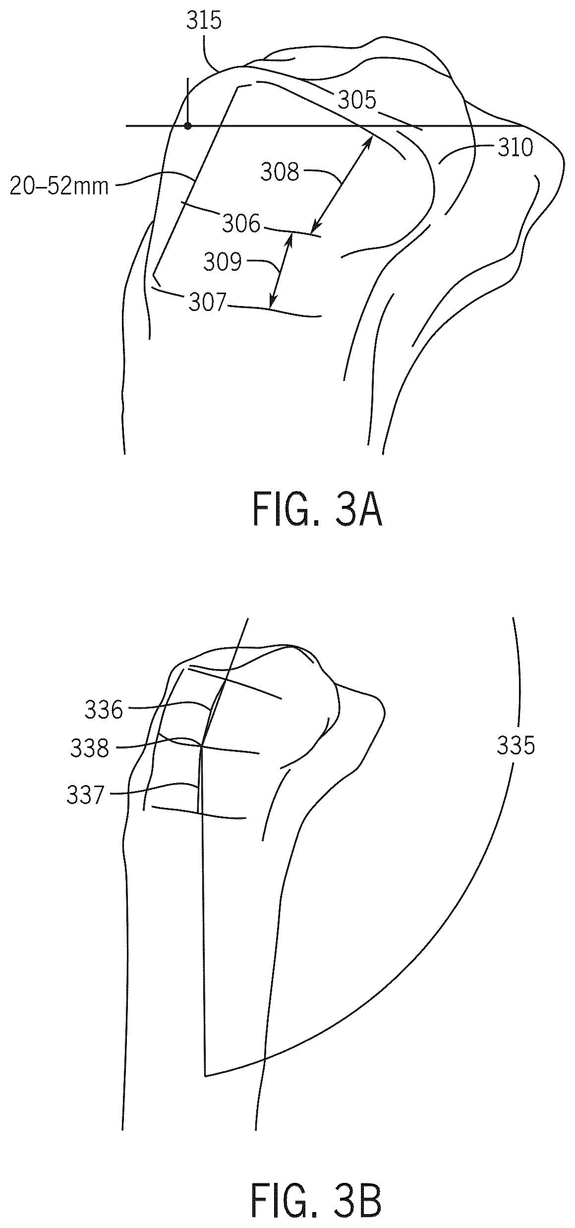 Patent US12496134 Figure 8 – Method for optimization of orthopedic component design