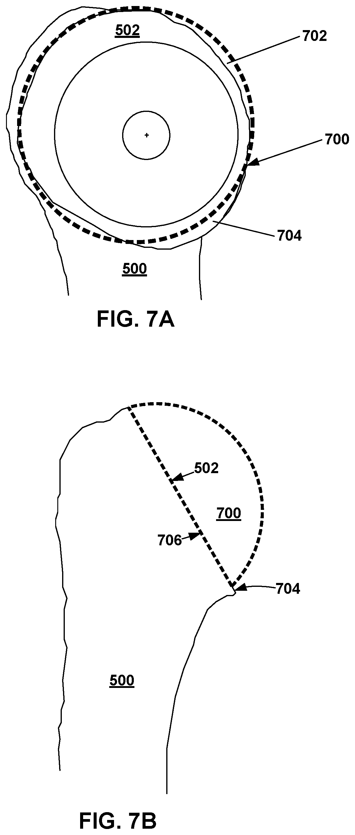 Patent US12496135 Figure 7 – Mixed-reality humeral-head sizing and placement