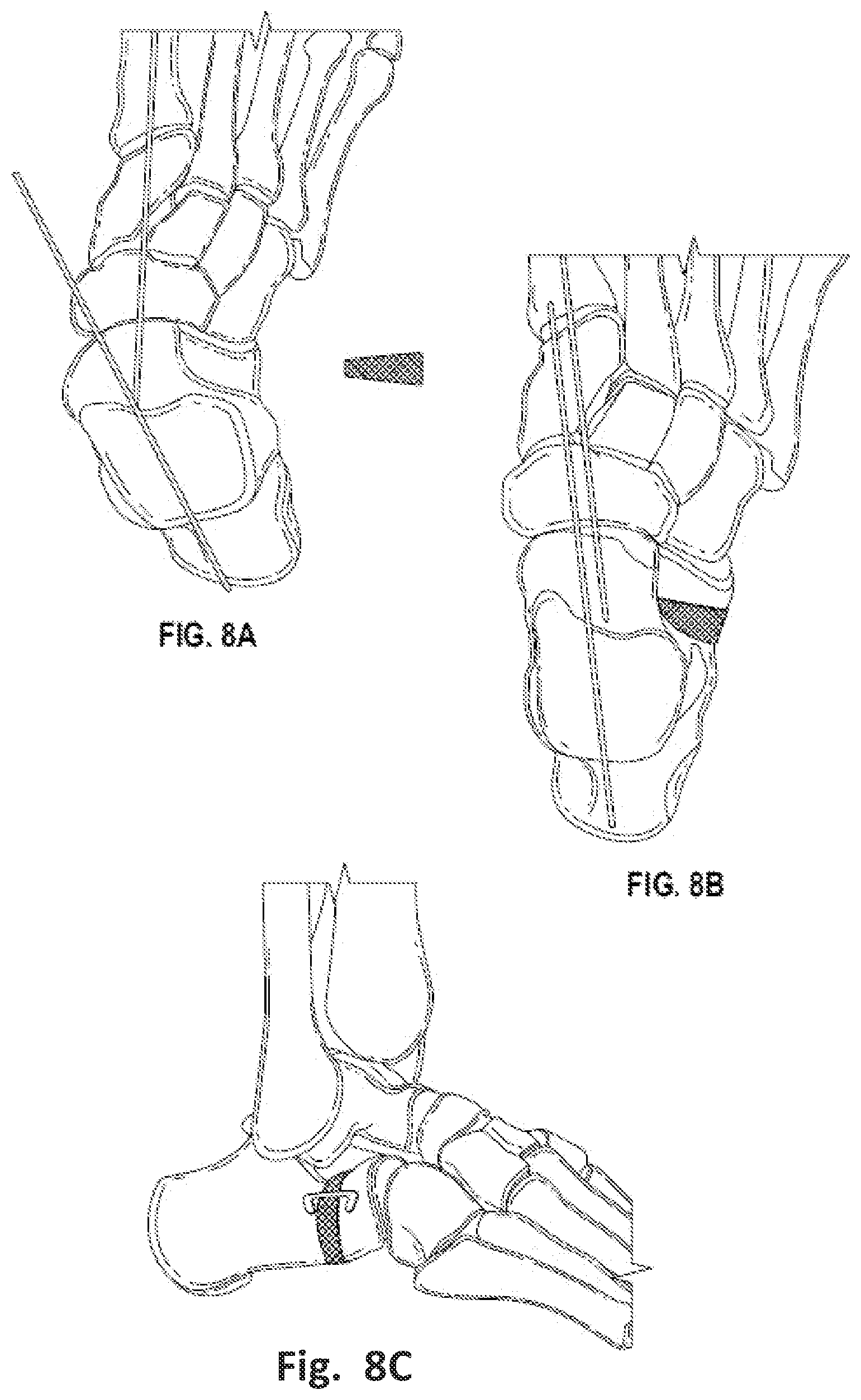 Patent US12496137 Figure 10 – Patient-specific osteotomy instrumentation