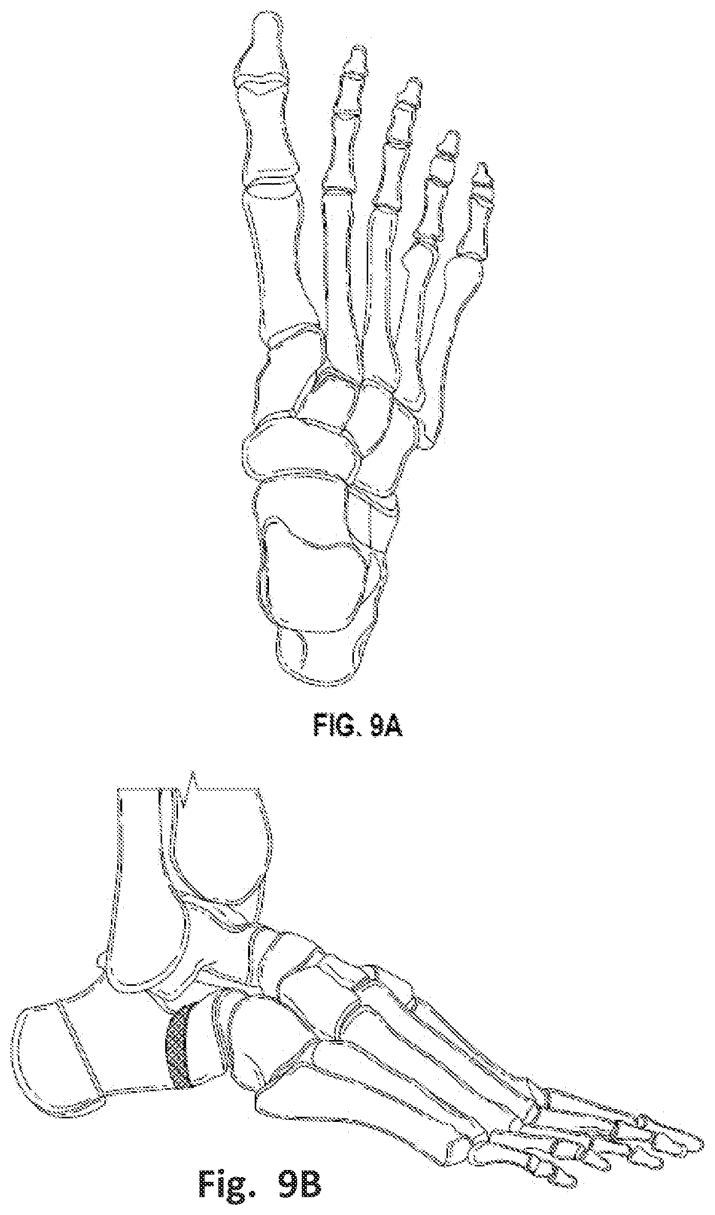 Patent US12496137 Figure 11 – Patient-specific osteotomy instrumentation