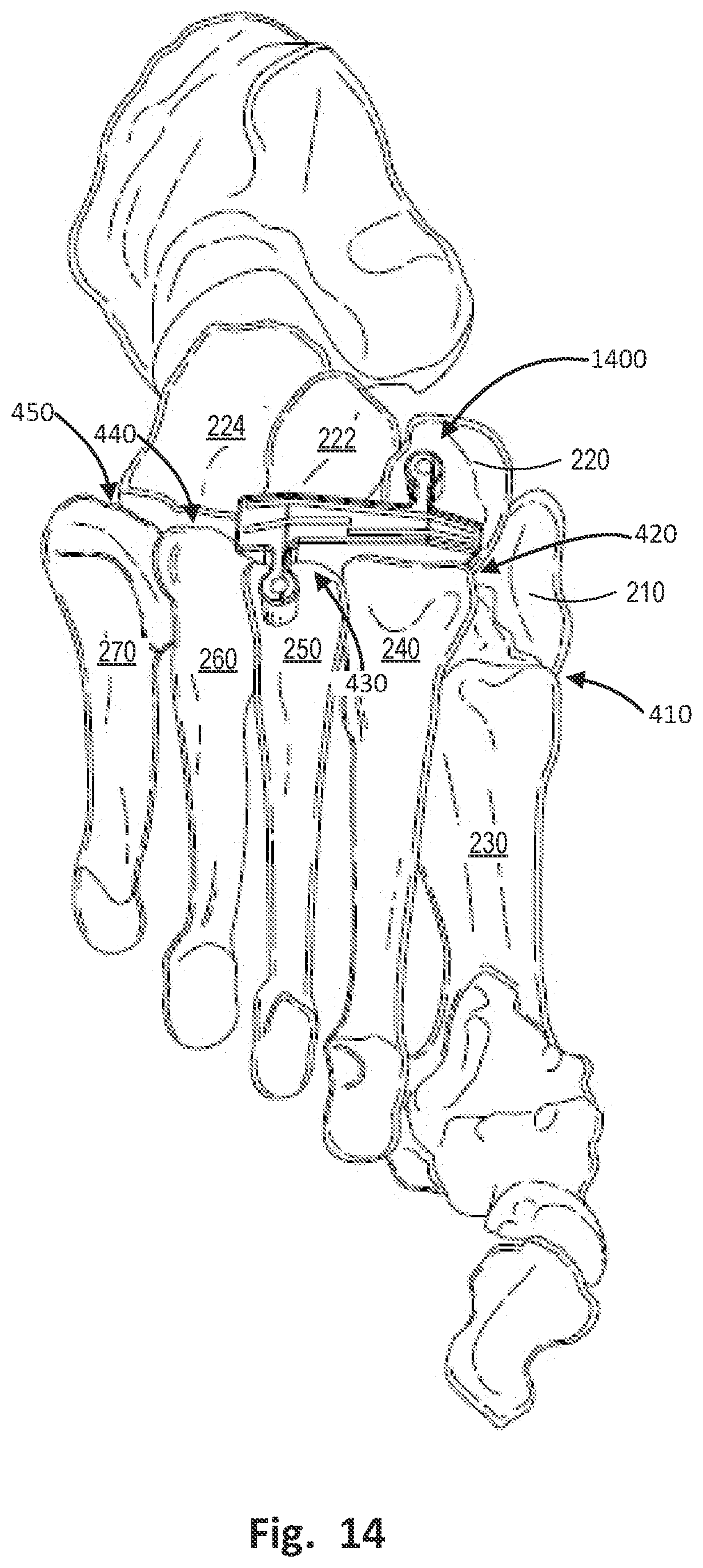 Patent US12496137 Figure 16 – Patient-specific osteotomy instrumentation