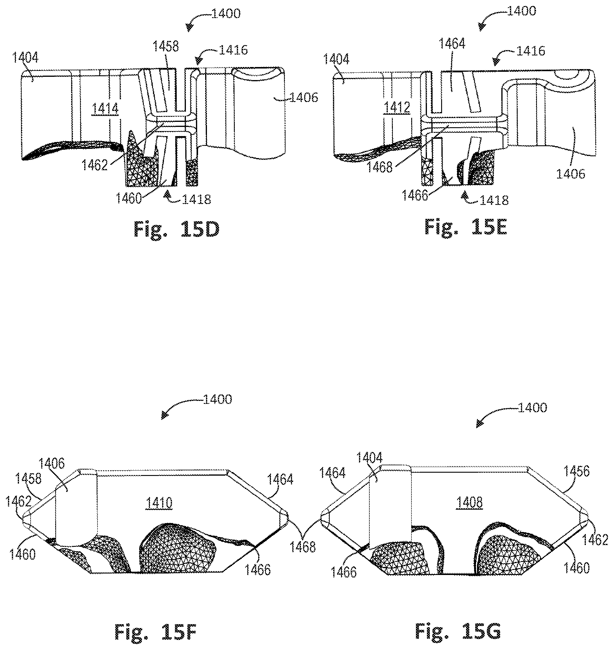 Patent US12496137 Figure 18 – Patient-specific osteotomy instrumentation