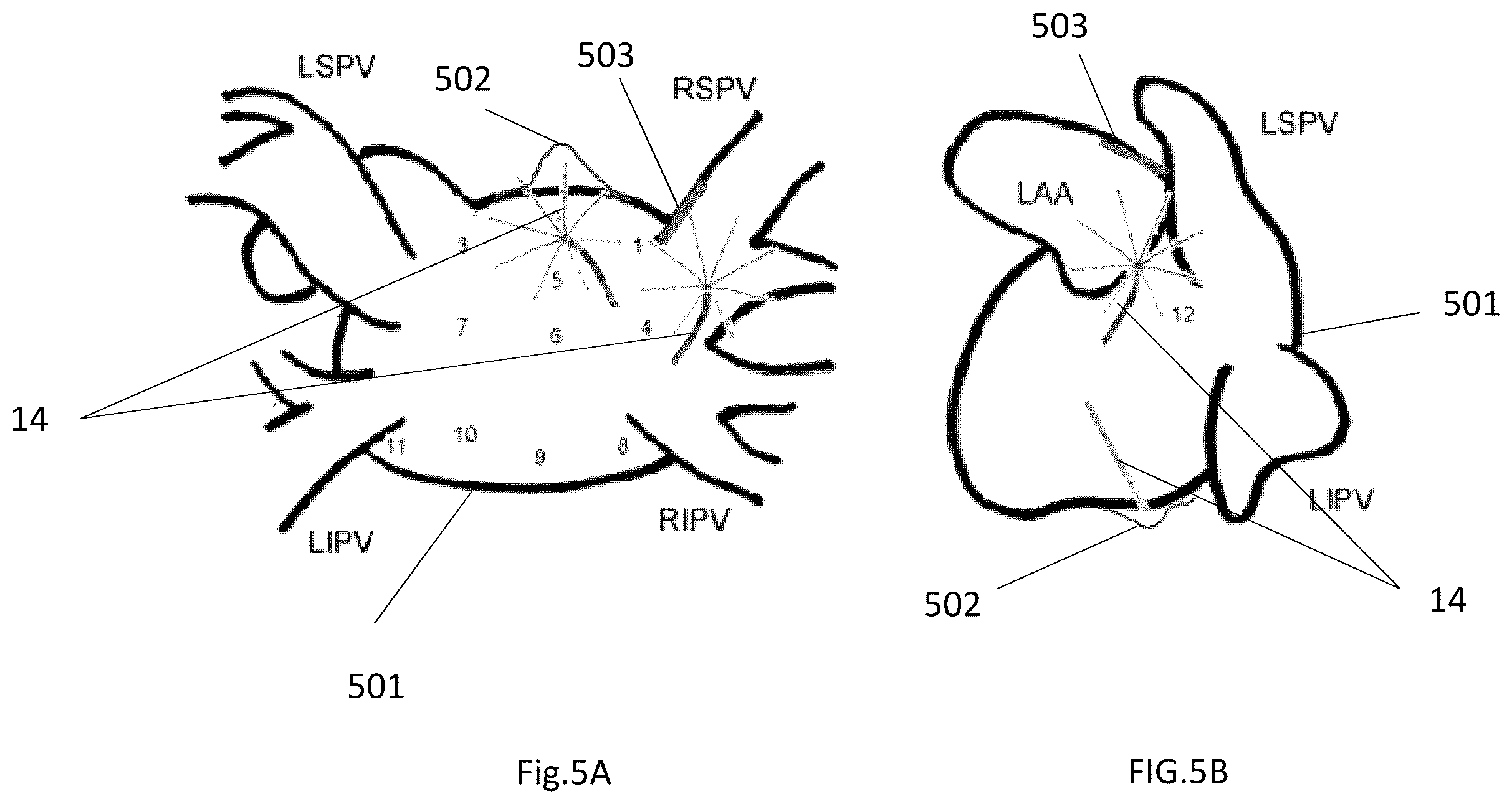 Patent US12496138 Figure 5 – Automated tool for identifying and correcting tenting artifacts in anatomical mapping