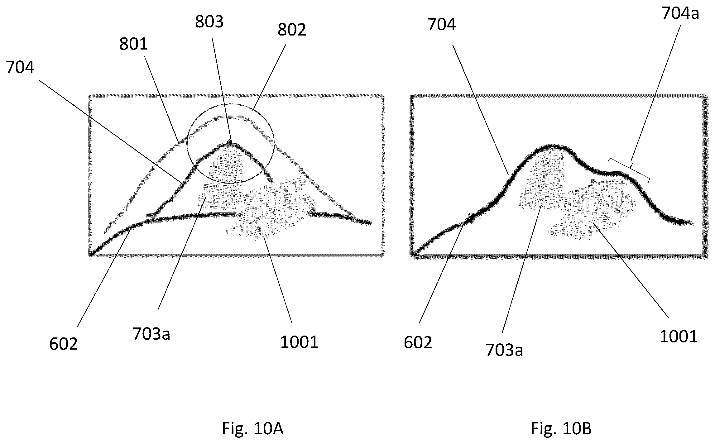 Patent US12496138 Figure 10 – Automated tool for identifying and correcting tenting artifacts in anatomical mapping