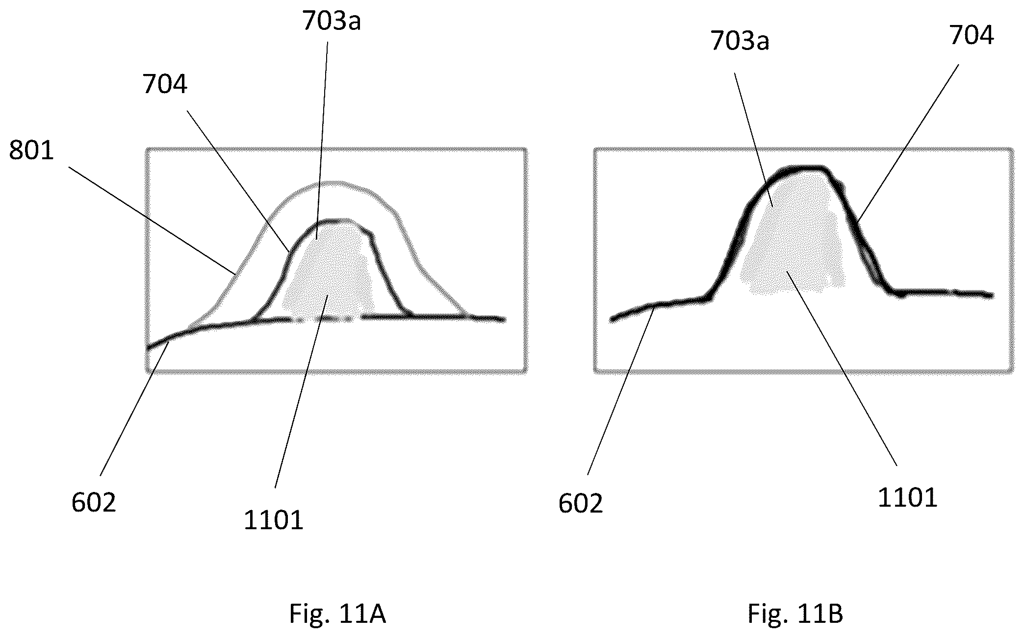 Patent US12496138 Figure 11 – Automated tool for identifying and correcting tenting artifacts in anatomical mapping