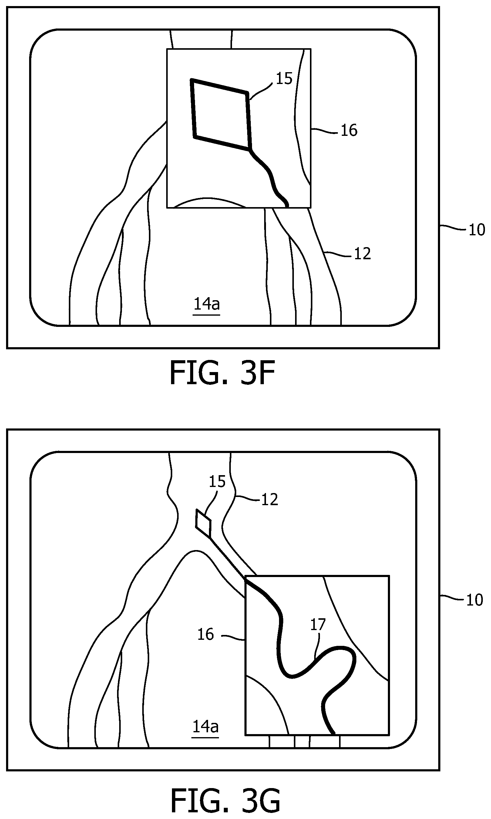 Patent US12496140 Figure 11 – Automatic field of view updating of position tracked interventional device