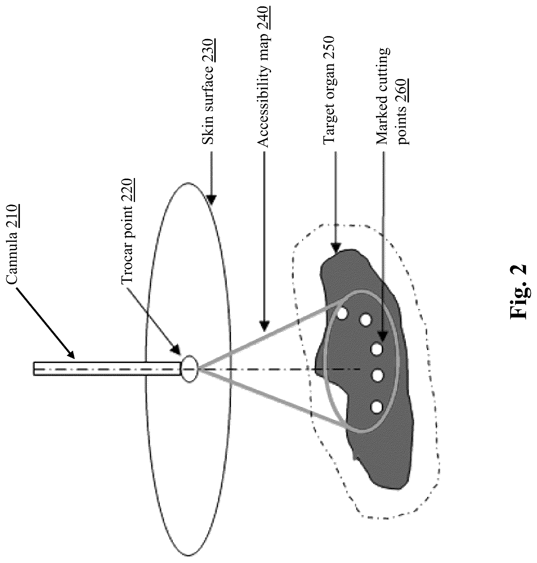 Patent US12496149 Figure 2 – System and method for automated simultaneous trocar and robot base location determination