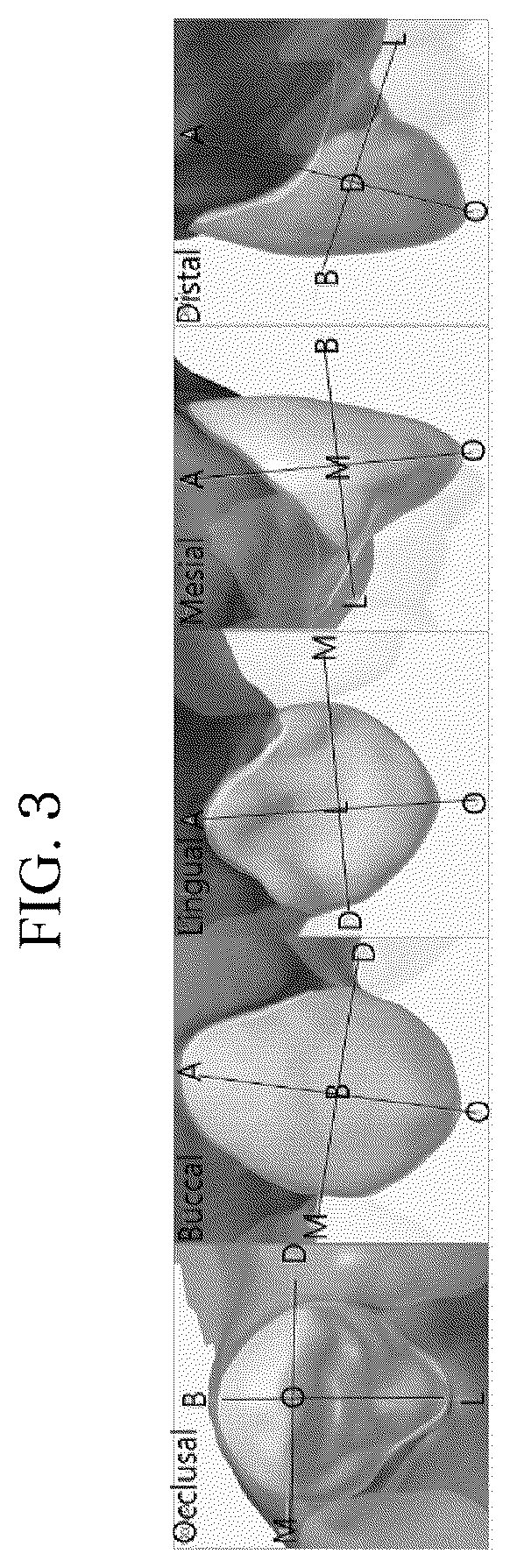 Patent US12496165 Figure 3 – Clear alignment attachment design method and clear aligners