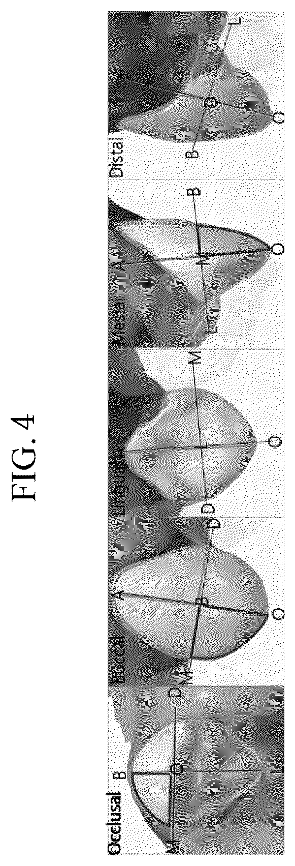 Patent US12496165 Figure 4 – Clear alignment attachment design method and clear aligners