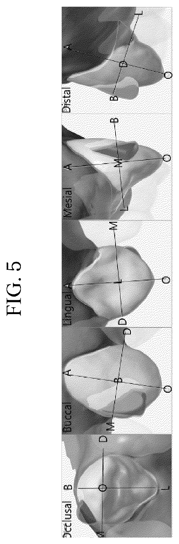 Patent US12496165 Figure 5 – Clear alignment attachment design method and clear aligners