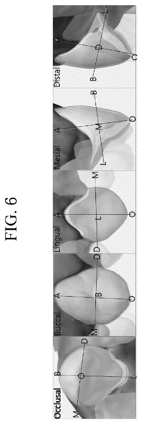 Patent US12496165 Figure 6 – Clear alignment attachment design method and clear aligners