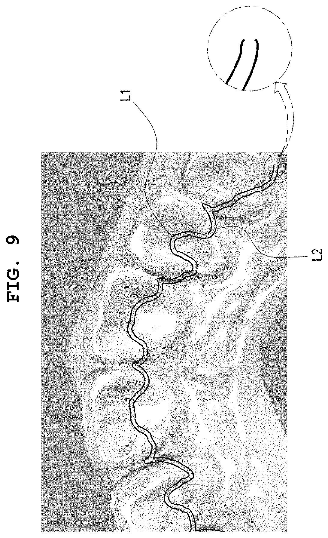 Patent US12496167 Figure 7 – Adhesive retainer and manufacturing method therefor