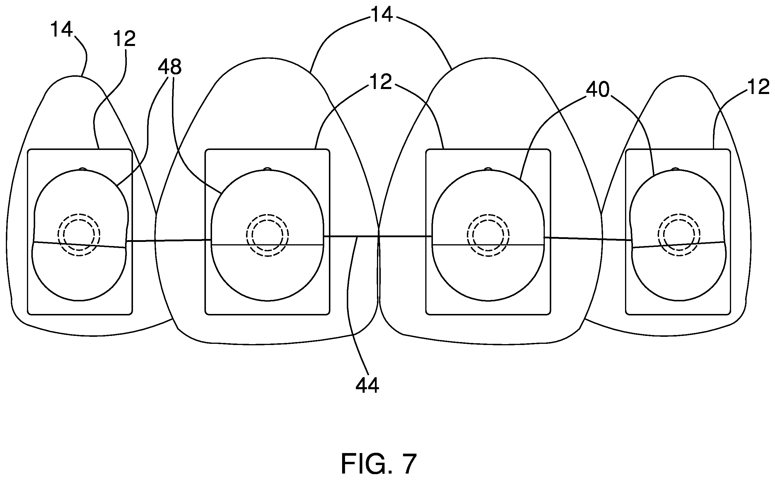 Patent US12496169 Figure 6 – Adjustable orthodontic assembly