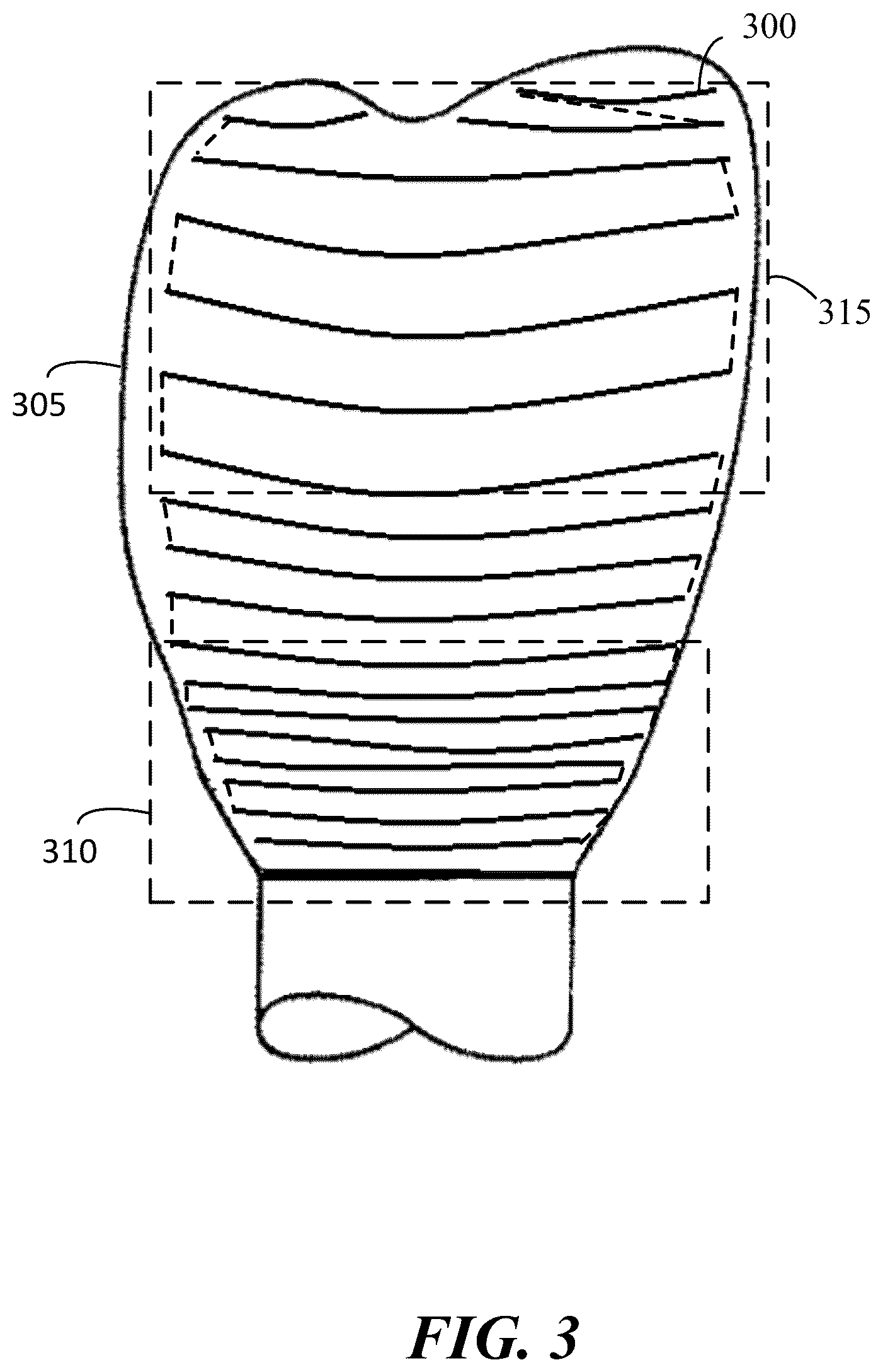 Patent US12496173 Figure 3 – Method for coloring a dental prosthesis