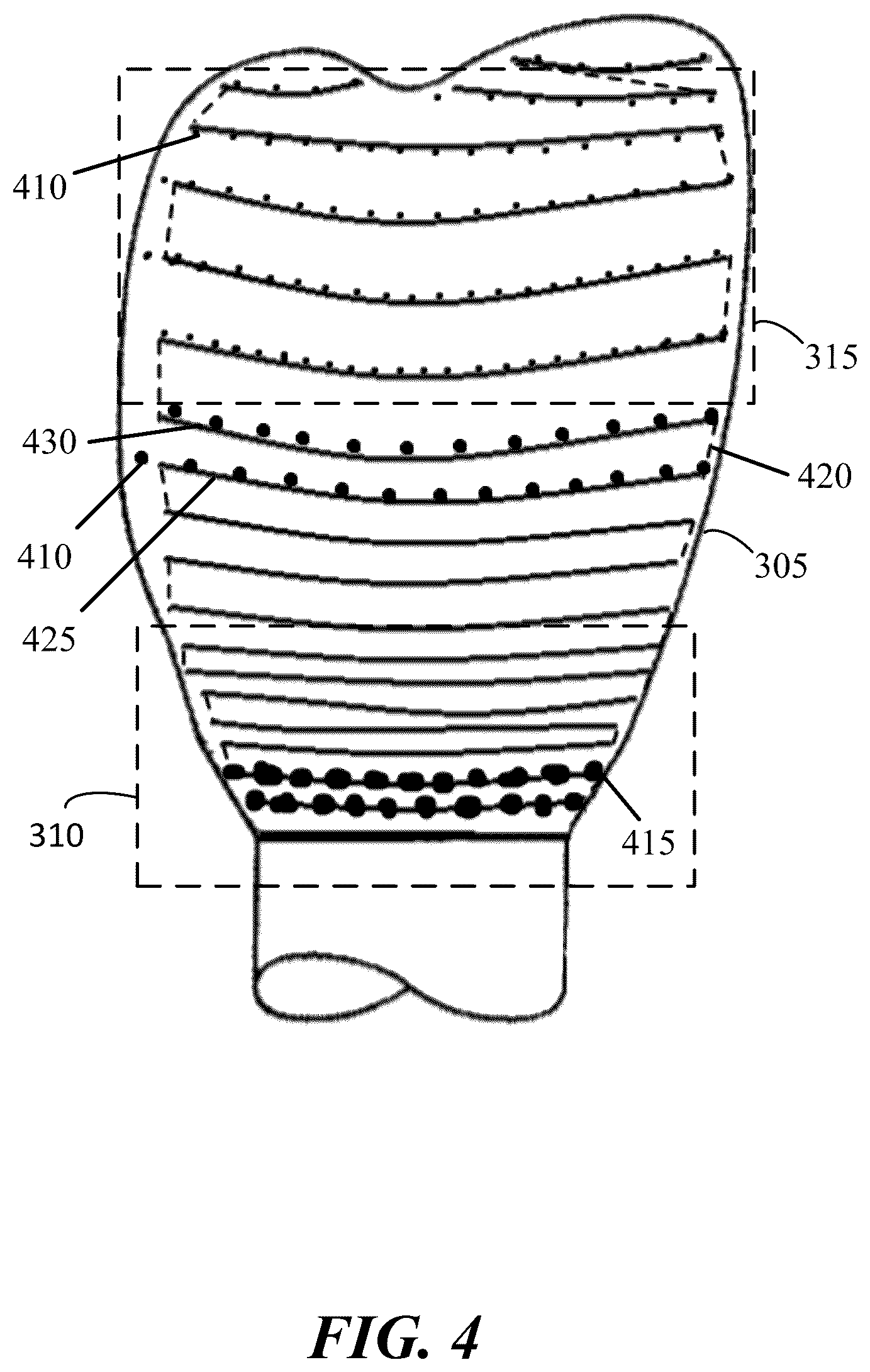 Patent US12496173 Figure 4 – Method for coloring a dental prosthesis