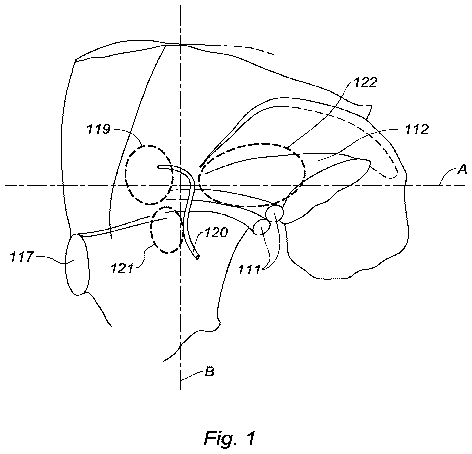 Patent US12496178 Figure 1 – Prosthesis for inguinal hernia repair