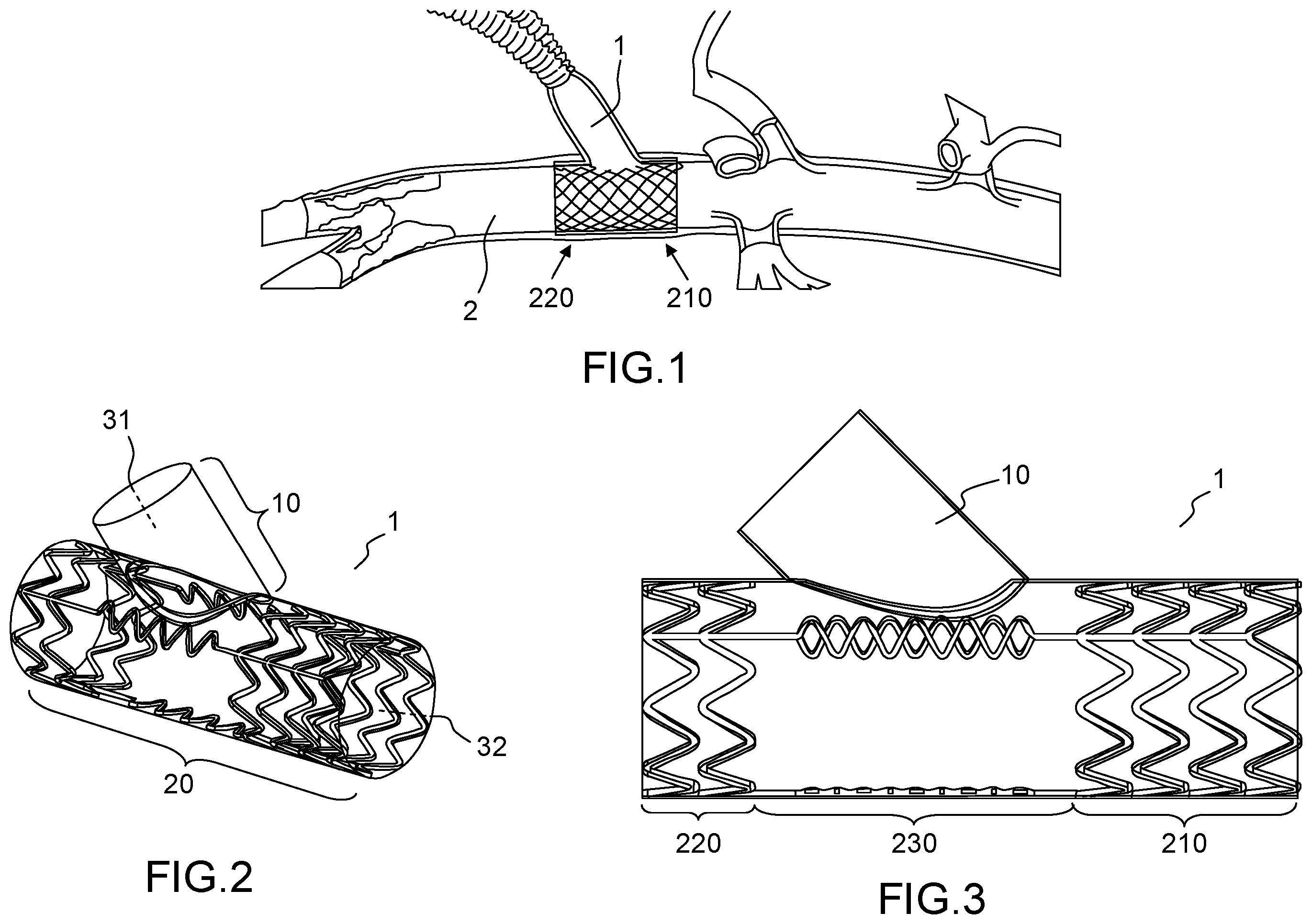 Patent US12496180 — Vascular prosthesis — Figure 1