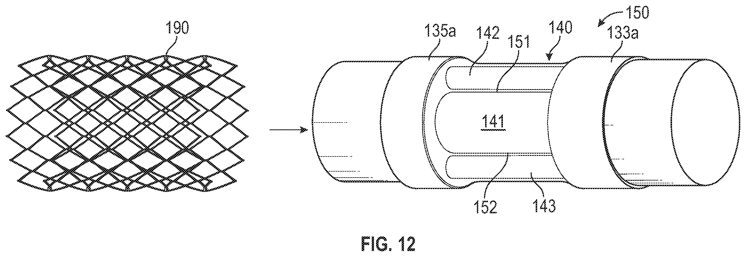 Patent US12496182 Figure 12 – Multi-lumen stent-graft and related surgical methods