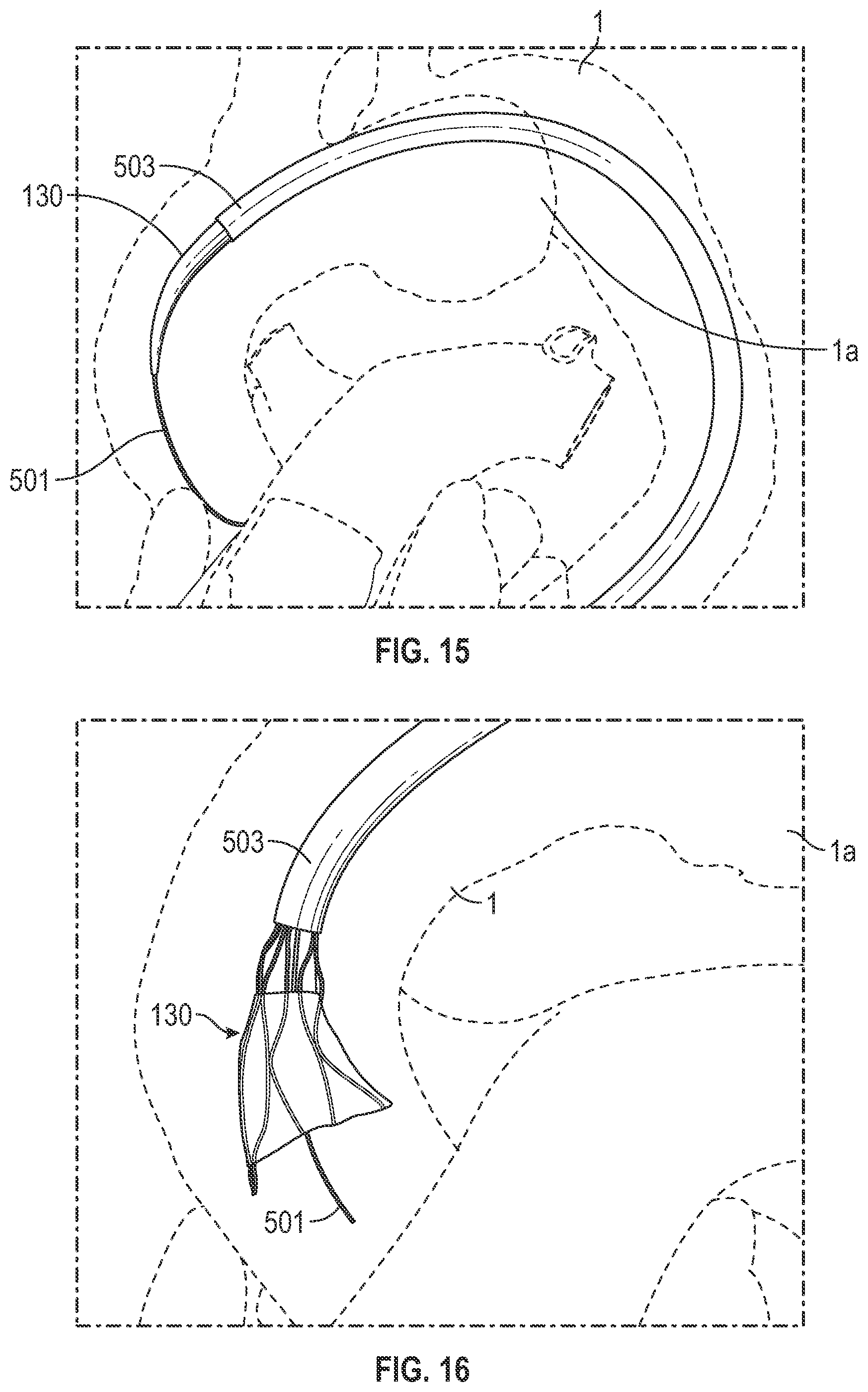 Patent US12496182 Figure 14 – Multi-lumen stent-graft and related surgical methods