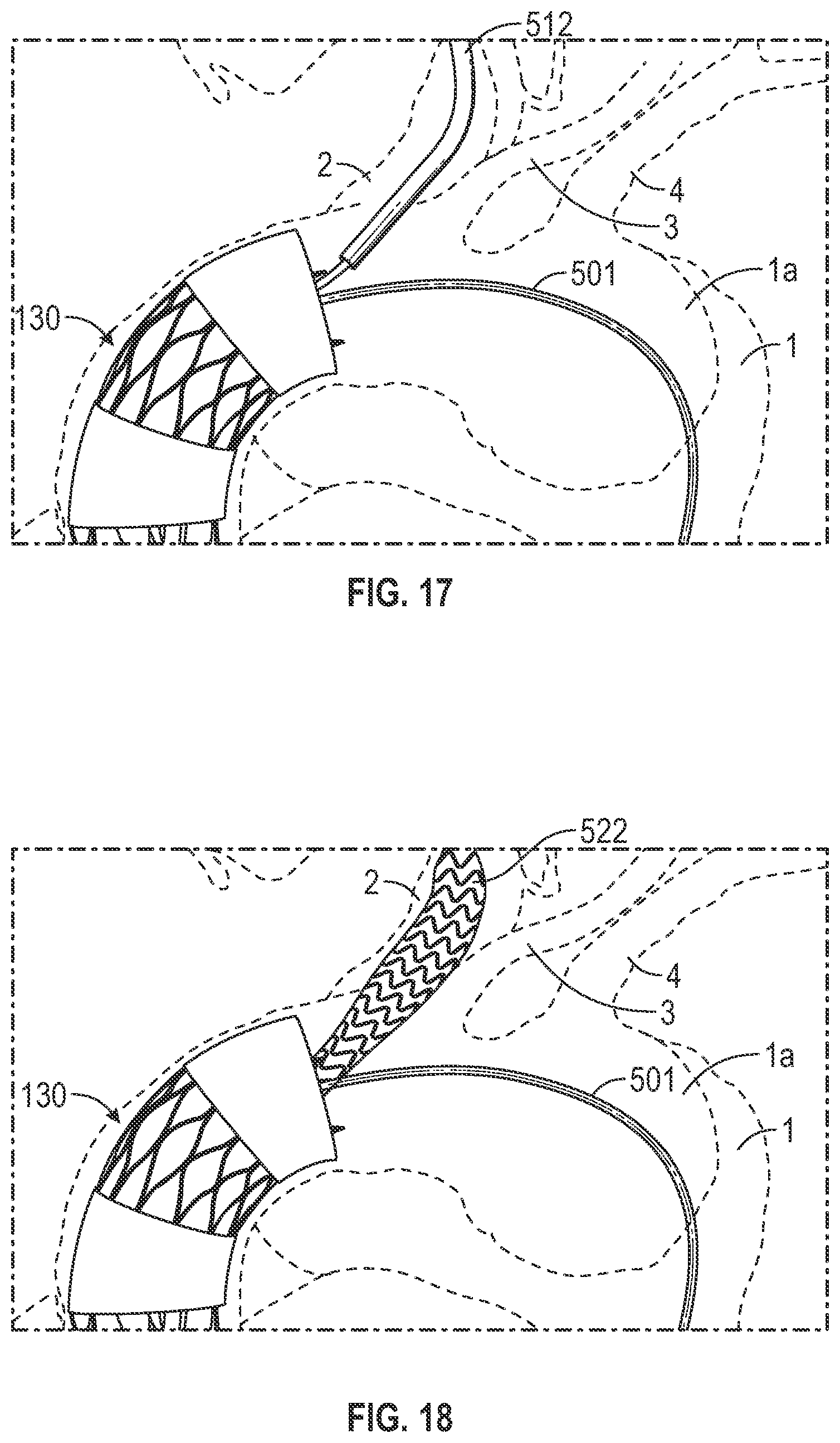 Patent US12496182 Figure 15 – Multi-lumen stent-graft and related surgical methods