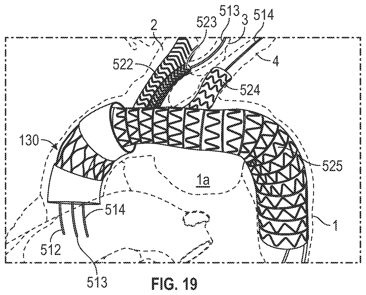 Patent US12496182 Figure 16 – Multi-lumen stent-graft and related surgical methods