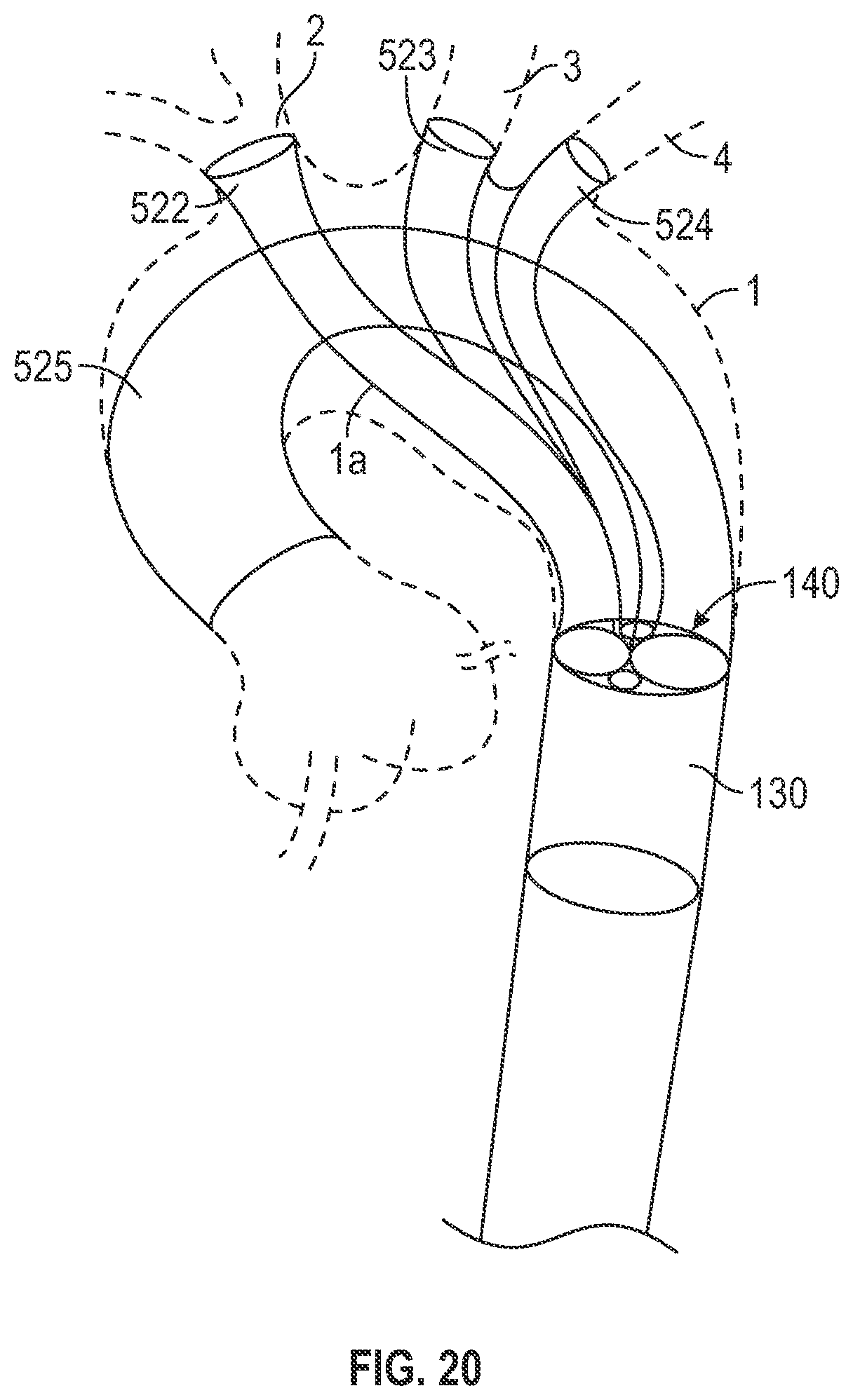 Patent US12496182 Figure 17 – Multi-lumen stent-graft and related surgical methods