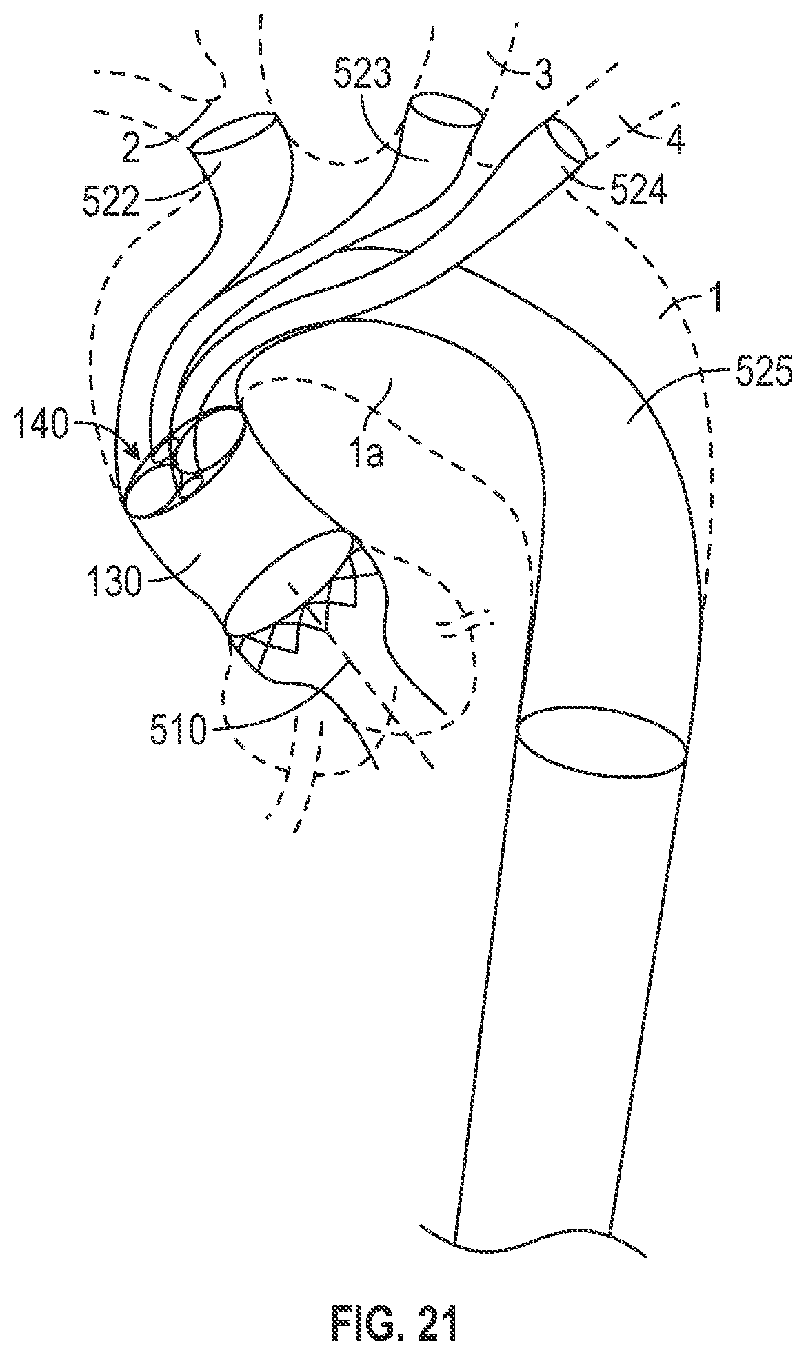 Patent US12496182 Figure 18 – Multi-lumen stent-graft and related surgical methods