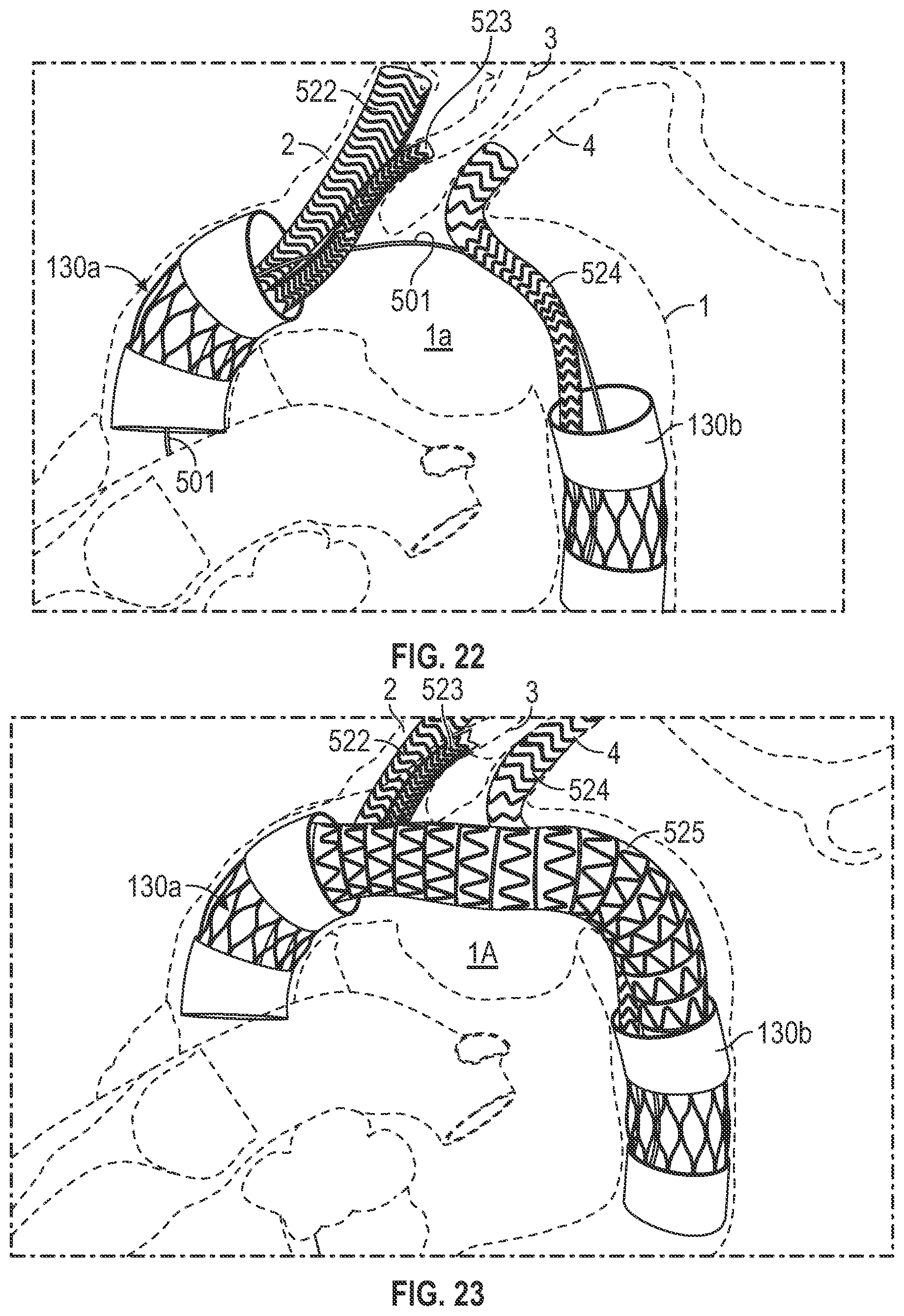 Patent US12496182 Figure 19 – Multi-lumen stent-graft and related surgical methods
