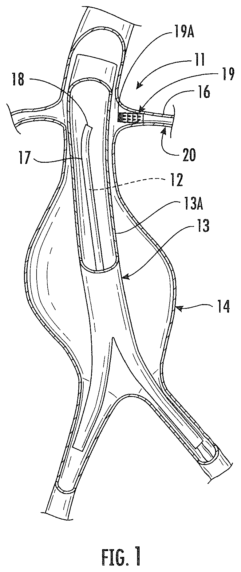 Patent US12496183 Figure 1 – System, method and treatment of aneurysms utilizing endographs