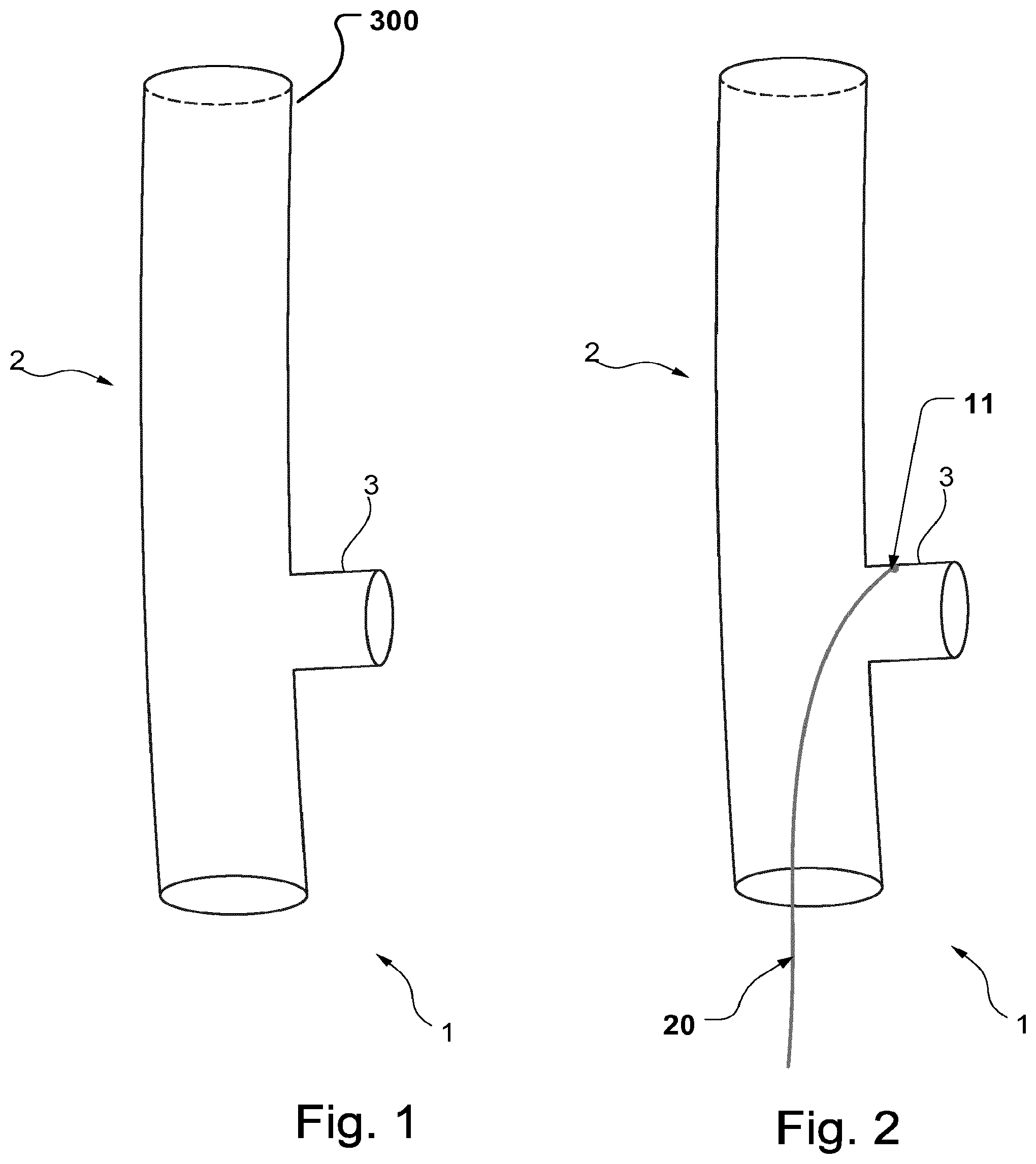 Patent US12496184 Figure 1 – Stent-graft prosthesis, system and method for improved delivery of a stent-graft prosthesis