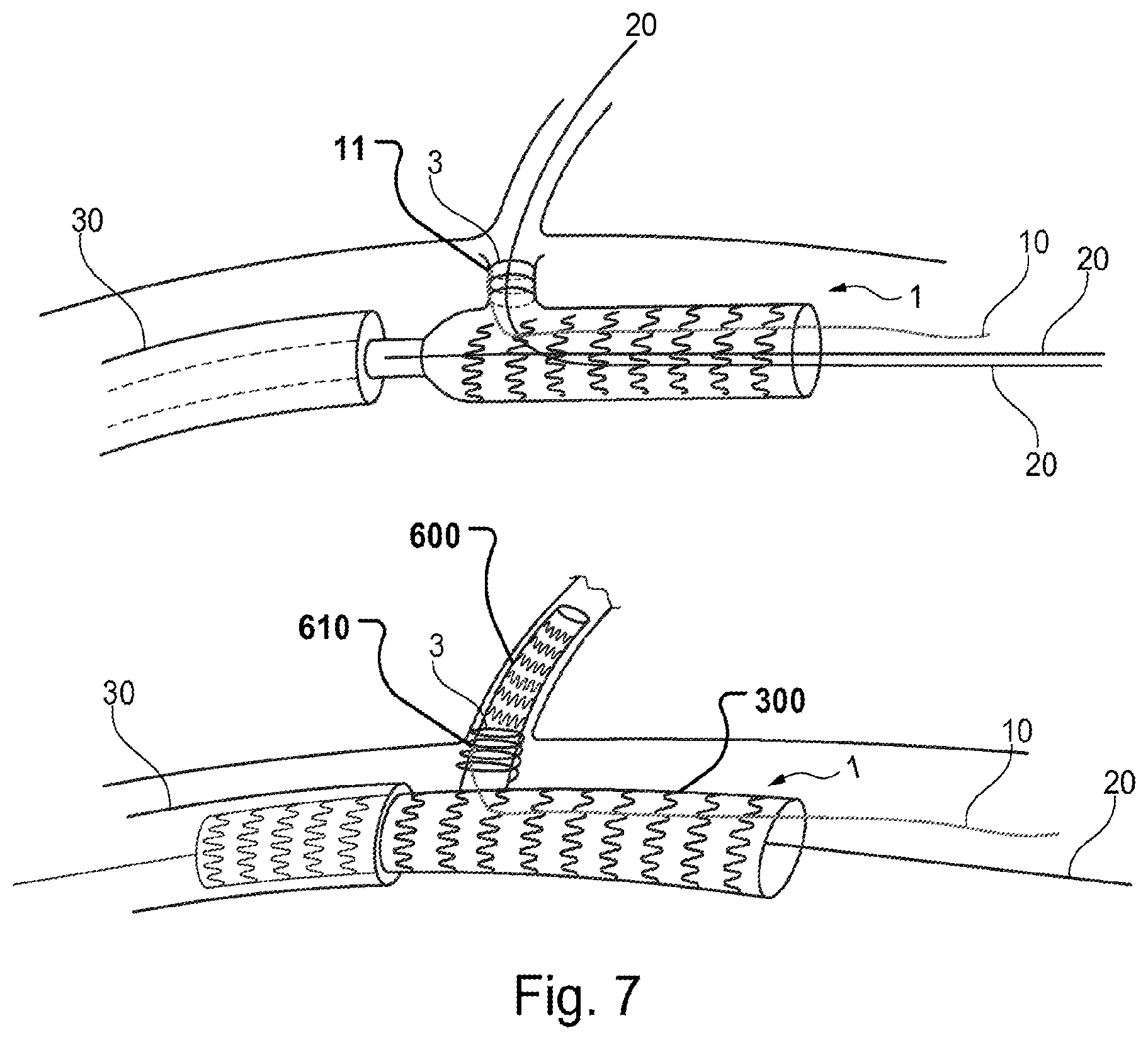 Patent US12496184 Figure 5 – Stent-graft prosthesis, system and method for improved delivery of a stent-graft prosthesis