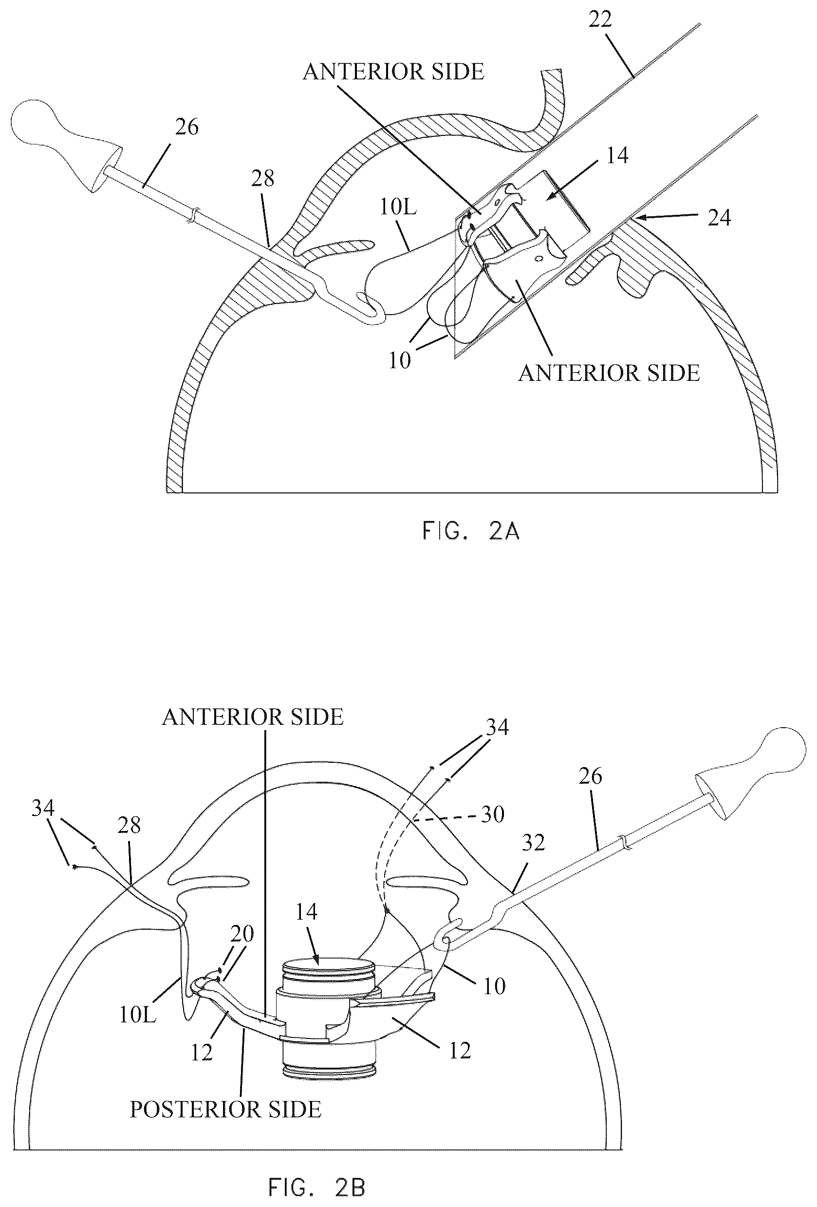 Patent US12496186 Figure 3 – Secondary haptic loops for fixation of intraocular device