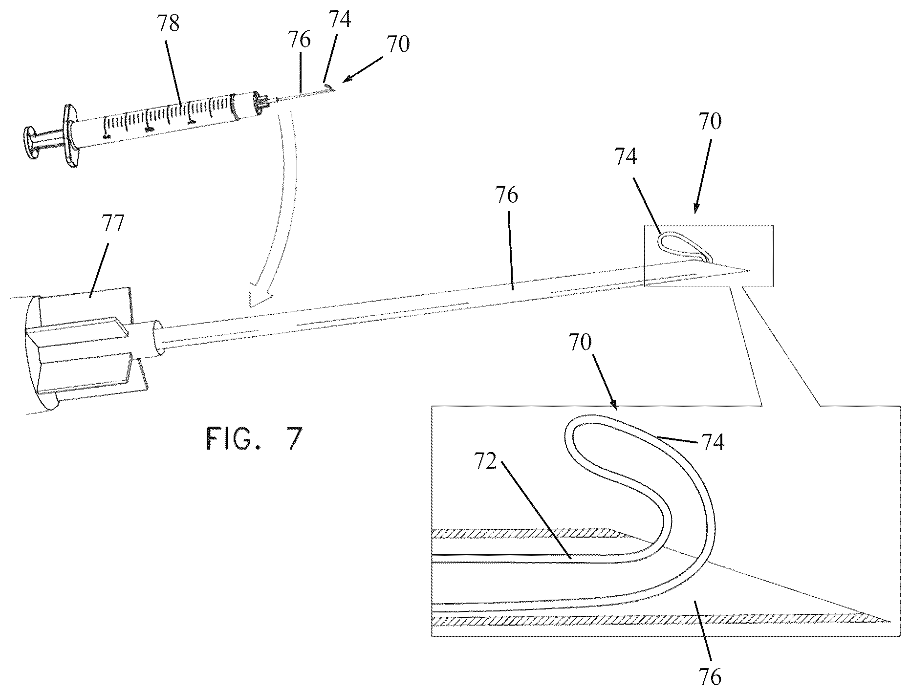 Patent US12496186 Figure 7 – Secondary haptic loops for fixation of intraocular device