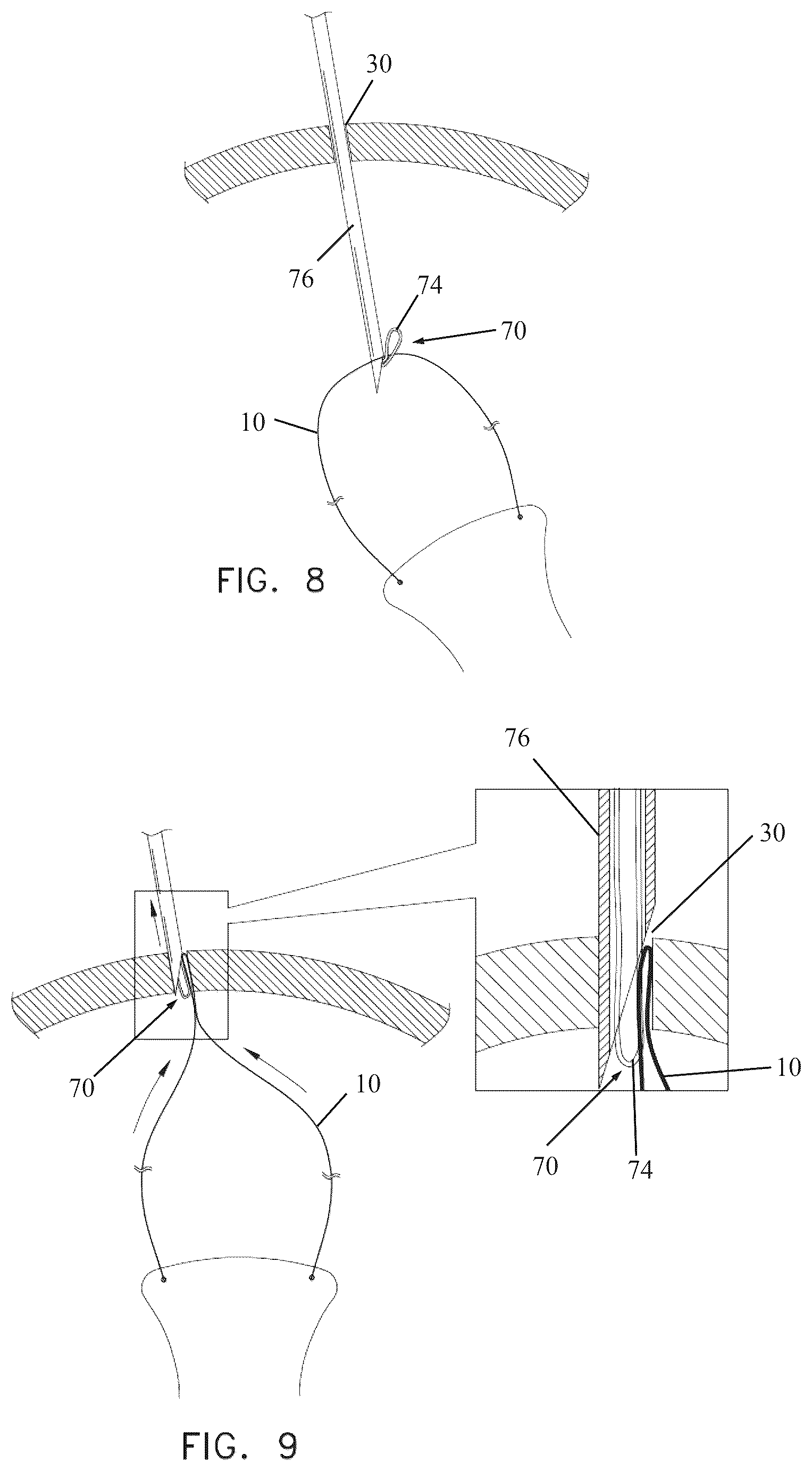 Patent US12496186 Figure 8 – Secondary haptic loops for fixation of intraocular device