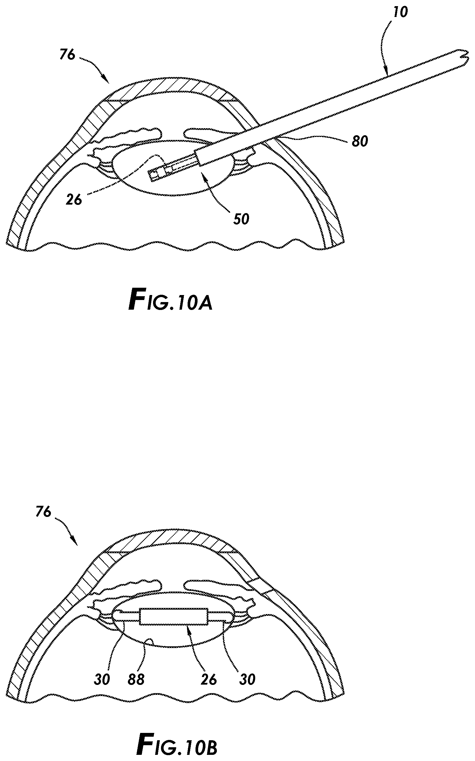 Patent US12496188 Figure 7 – Retractable cap actuation for an intraocular lens cartridge
