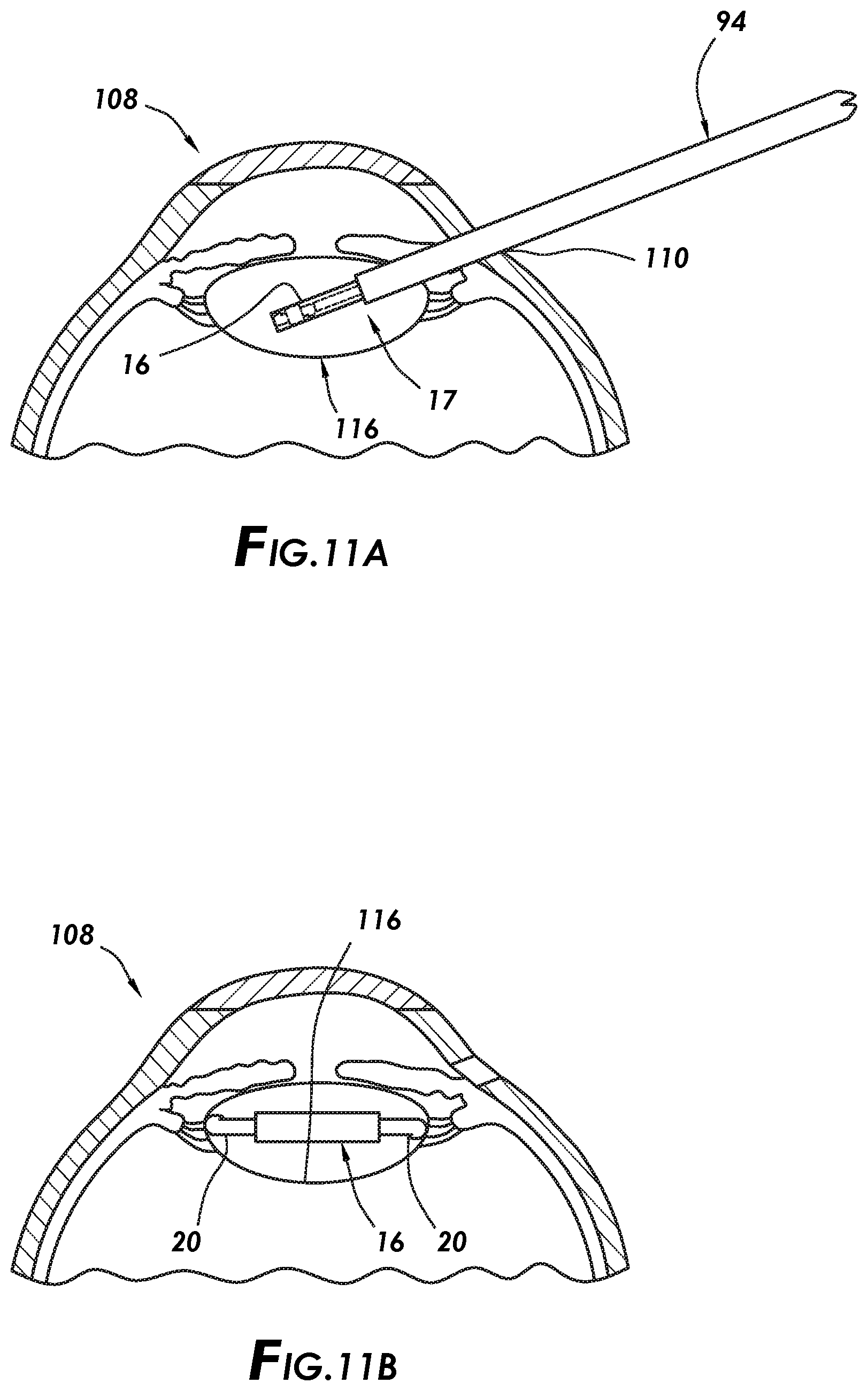 Patent US12496189 Figure 8 – Packaging-integrated manually actuated intraocular lens cartridge