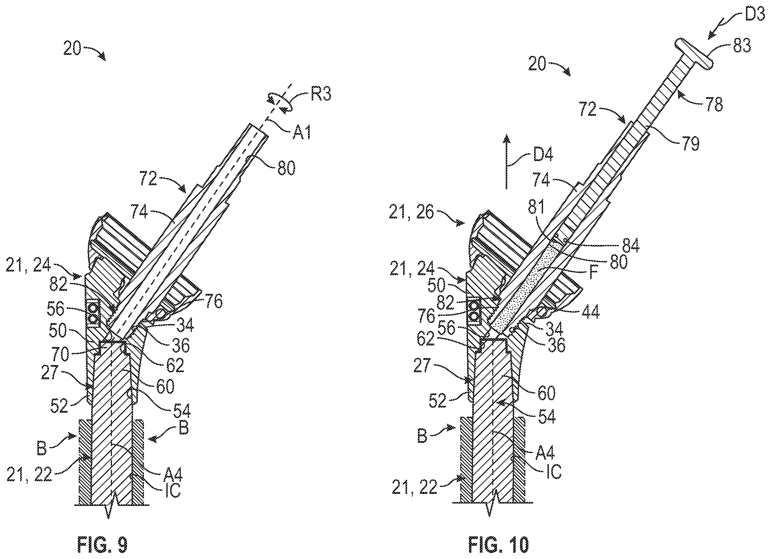 Patent US12496192 Figure 6 – Hydraulic taper separator for orthopaedic implant systems and methods of disassembly