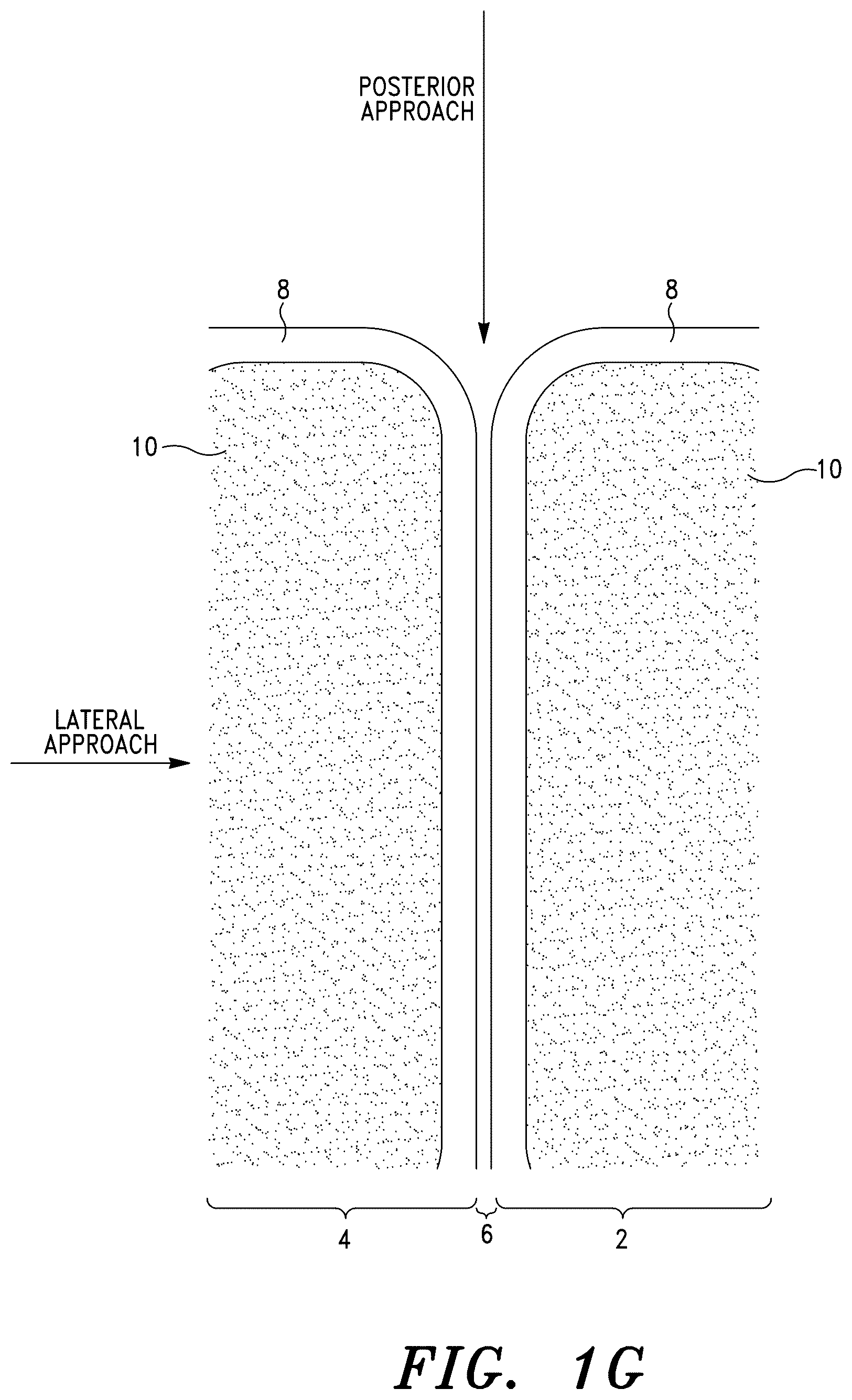 Patent US12496193 Figure 6 – Methods for sacroiliac joint stabilization
