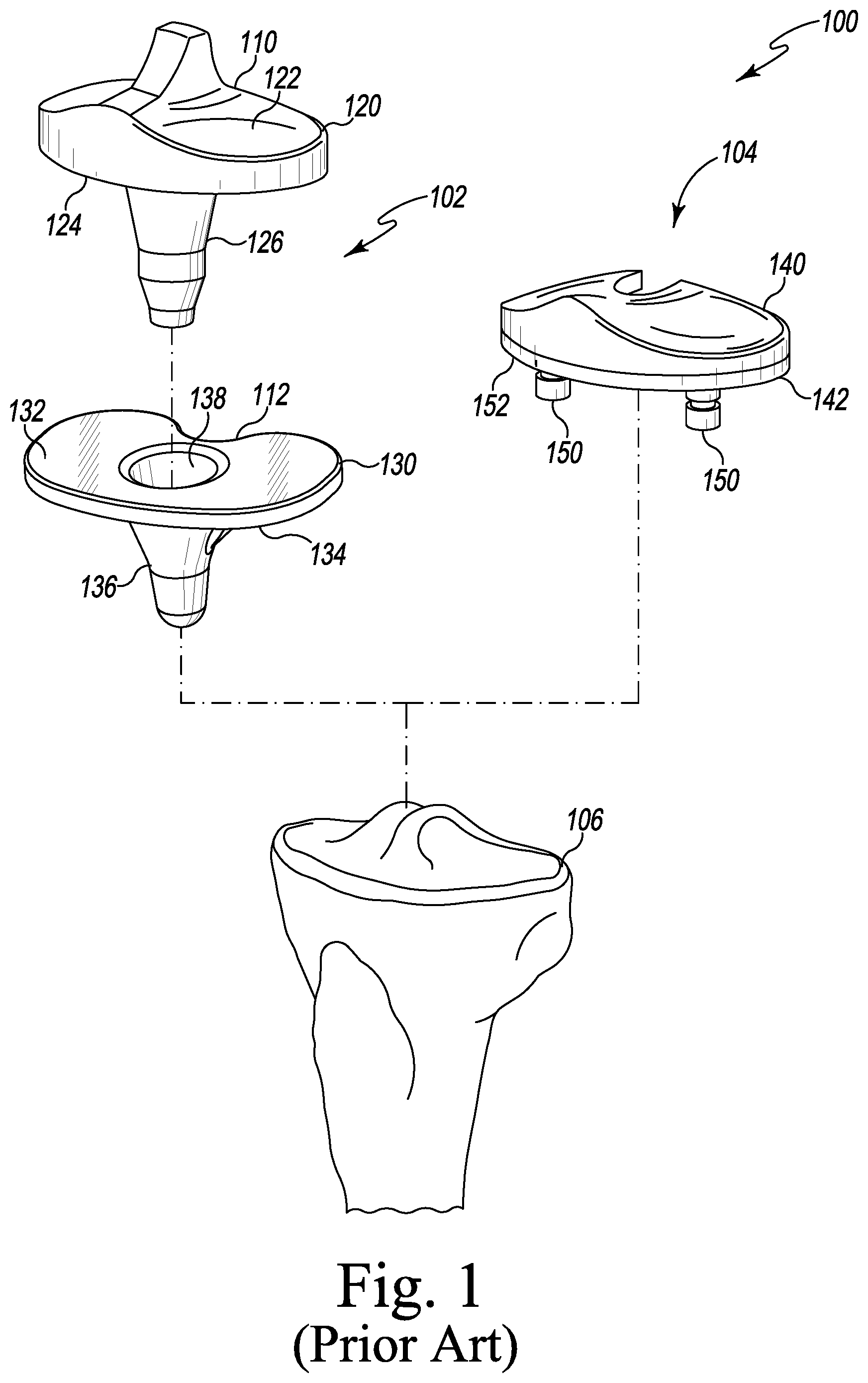 Patent US12496194 Figure 1 – Orthopaedic implant system with bone conserving features