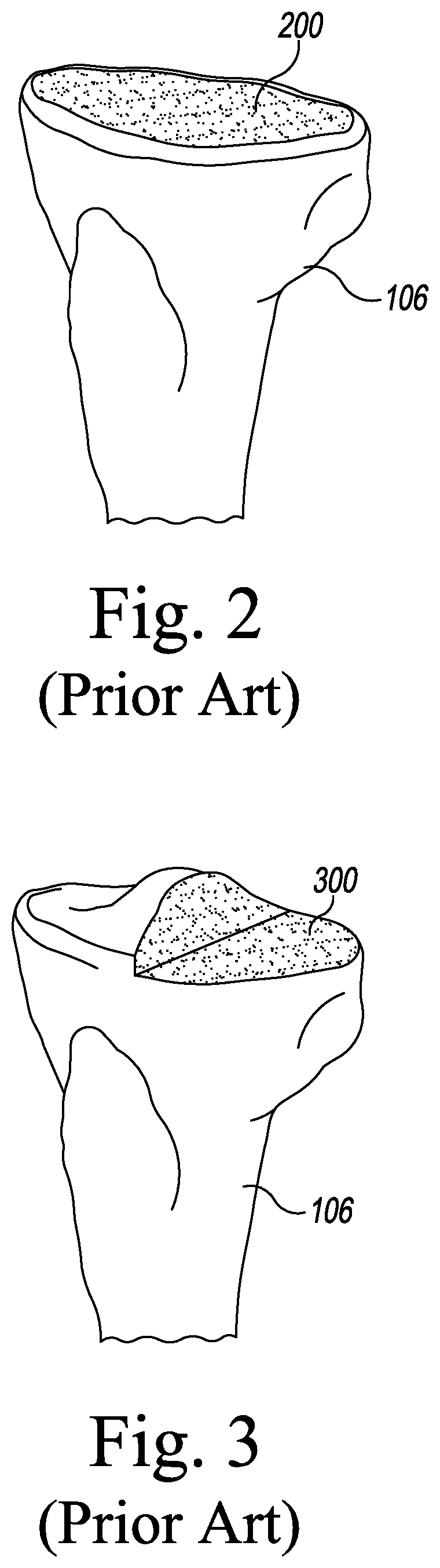 Patent US12496194 Figure 2 – Orthopaedic implant system with bone conserving features