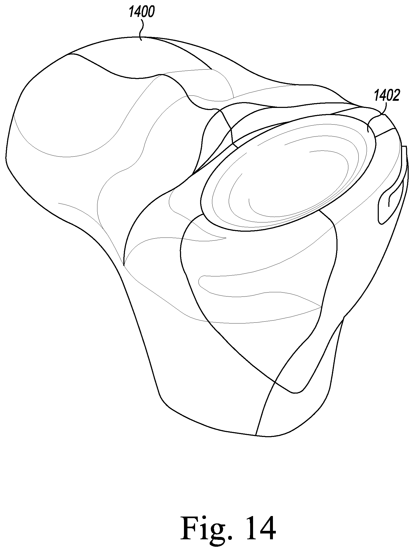 Patent US12496194 Figure 7 – Orthopaedic implant system with bone conserving features