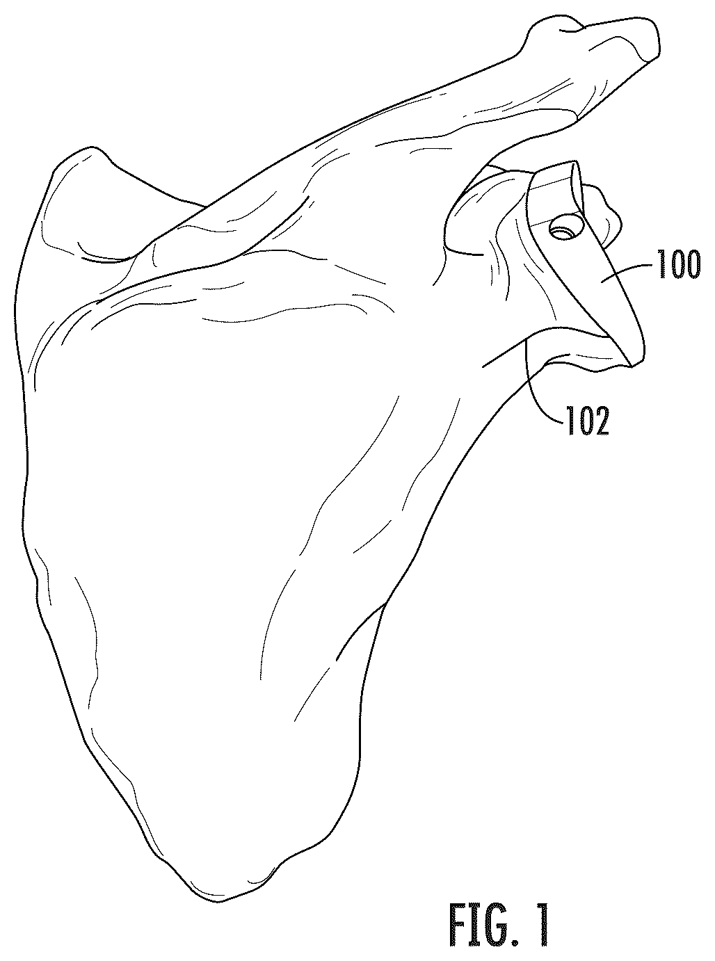 Patent US12496195 — Systems and methods of a glenoid component — Figure 1