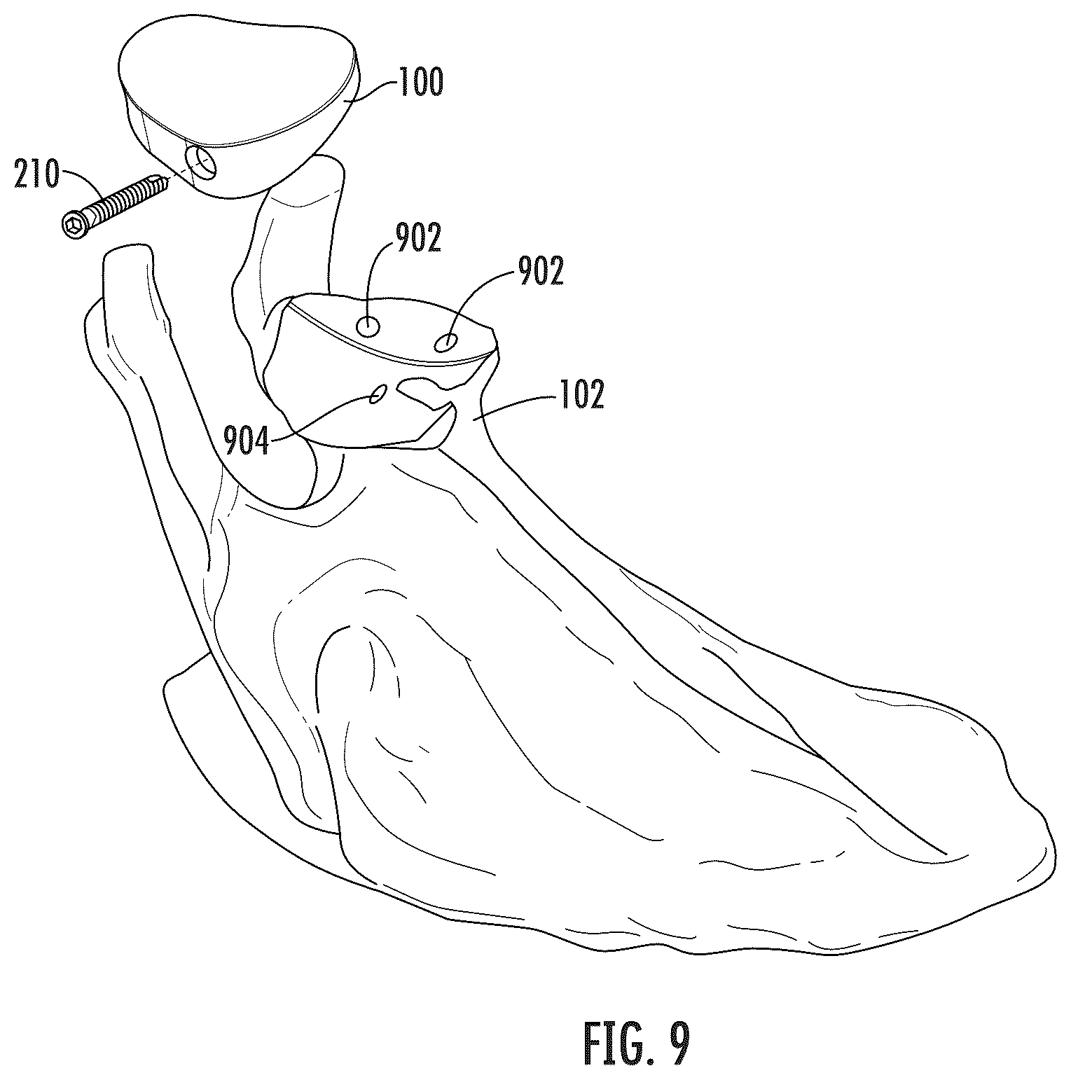 Patent US12496195 Figure 9 – Systems and methods of a glenoid component