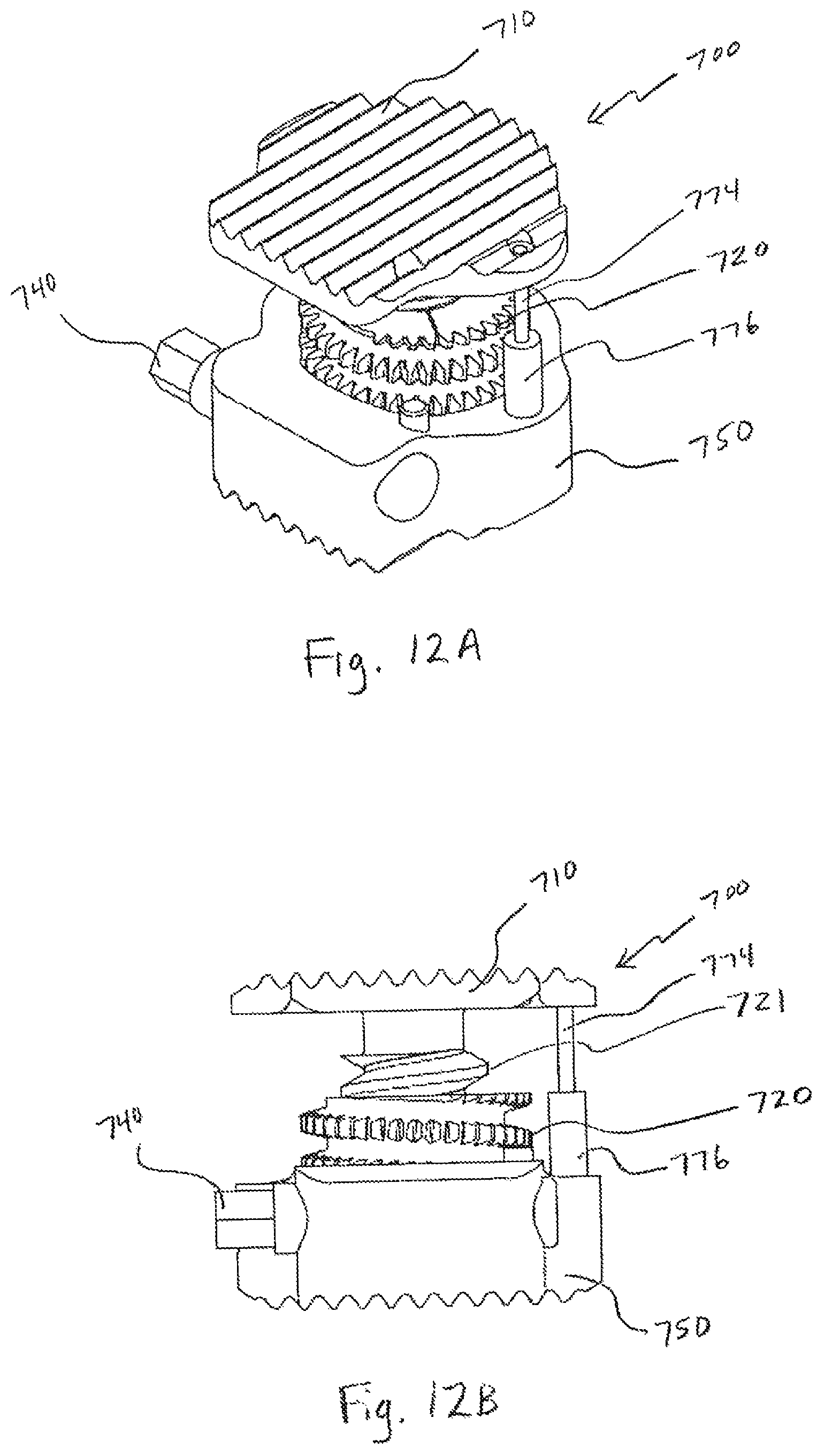 Patent US12496197 Figure 17 – Medical device employing a coaxial screw gear sleeve mechanism