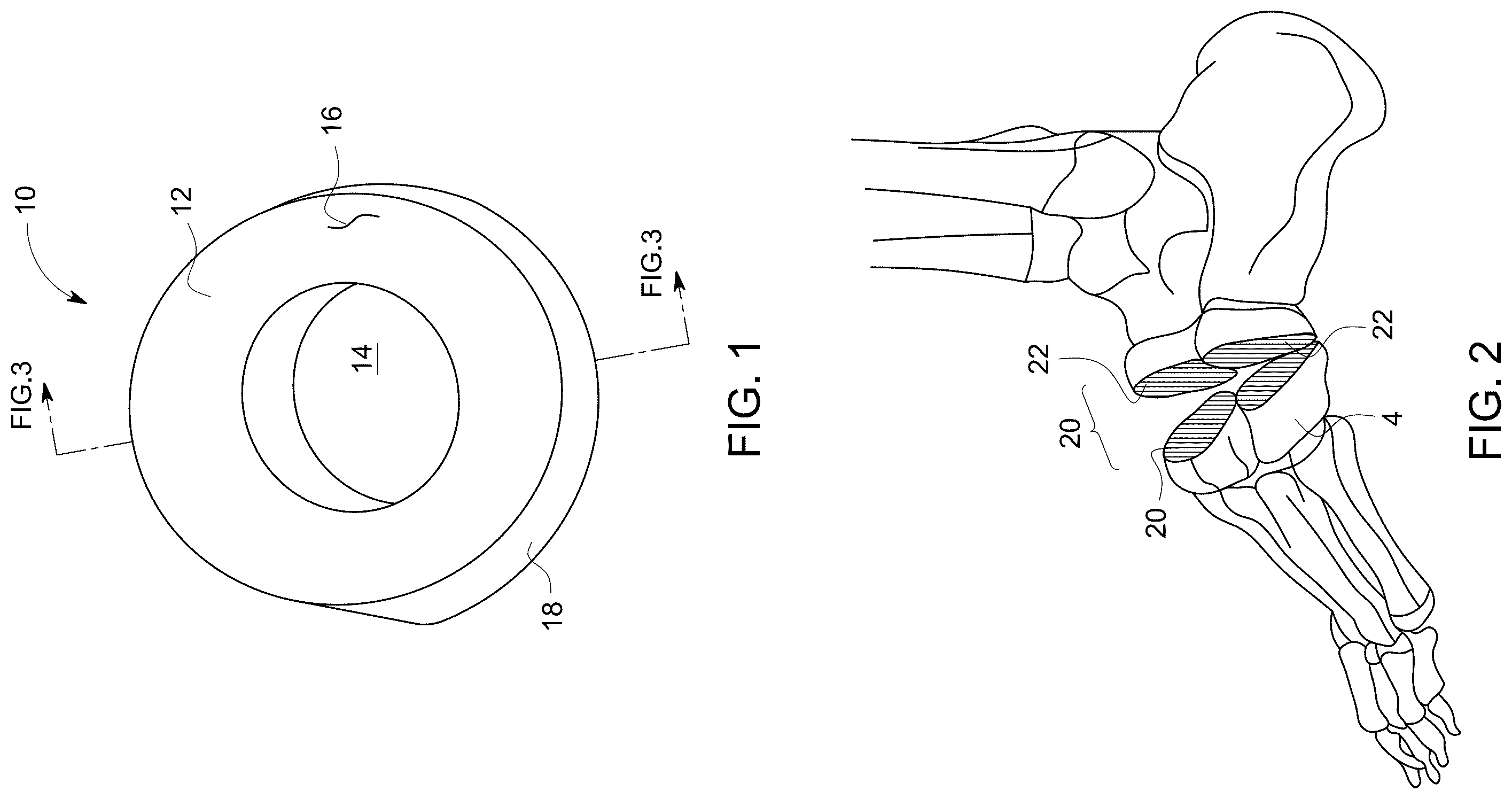 Patent US12496198 Figure 1 – Dowel guide instrument and method for treating mid-foot disorders