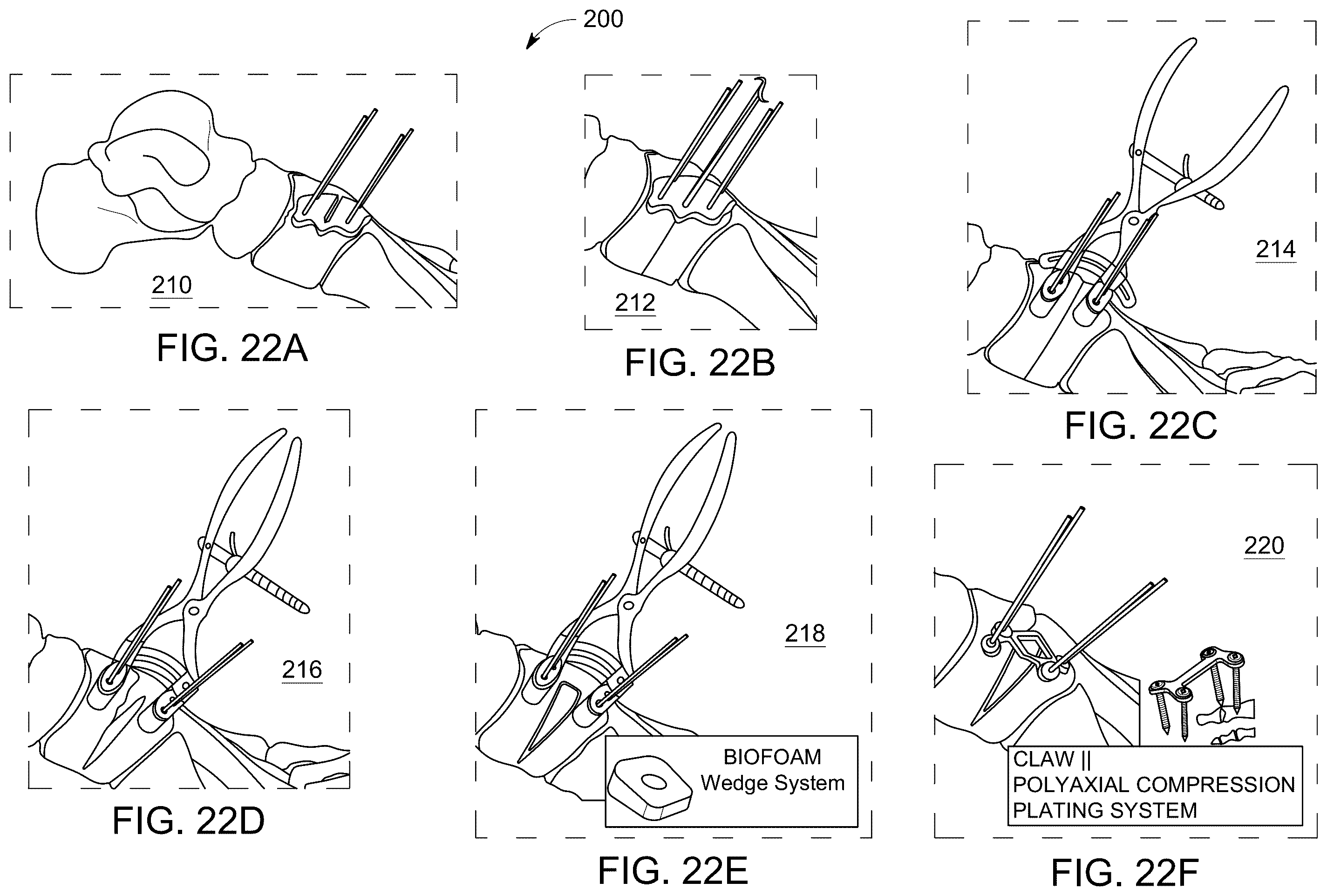Patent US12496198 Figure 13 – Dowel guide instrument and method for treating mid-foot disorders