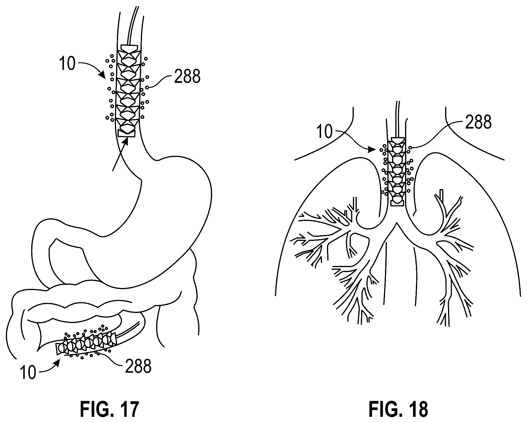 Patent US12496200 Figure 9 – Kirigami-inspired stents for sustained local delivery of therapeutics
