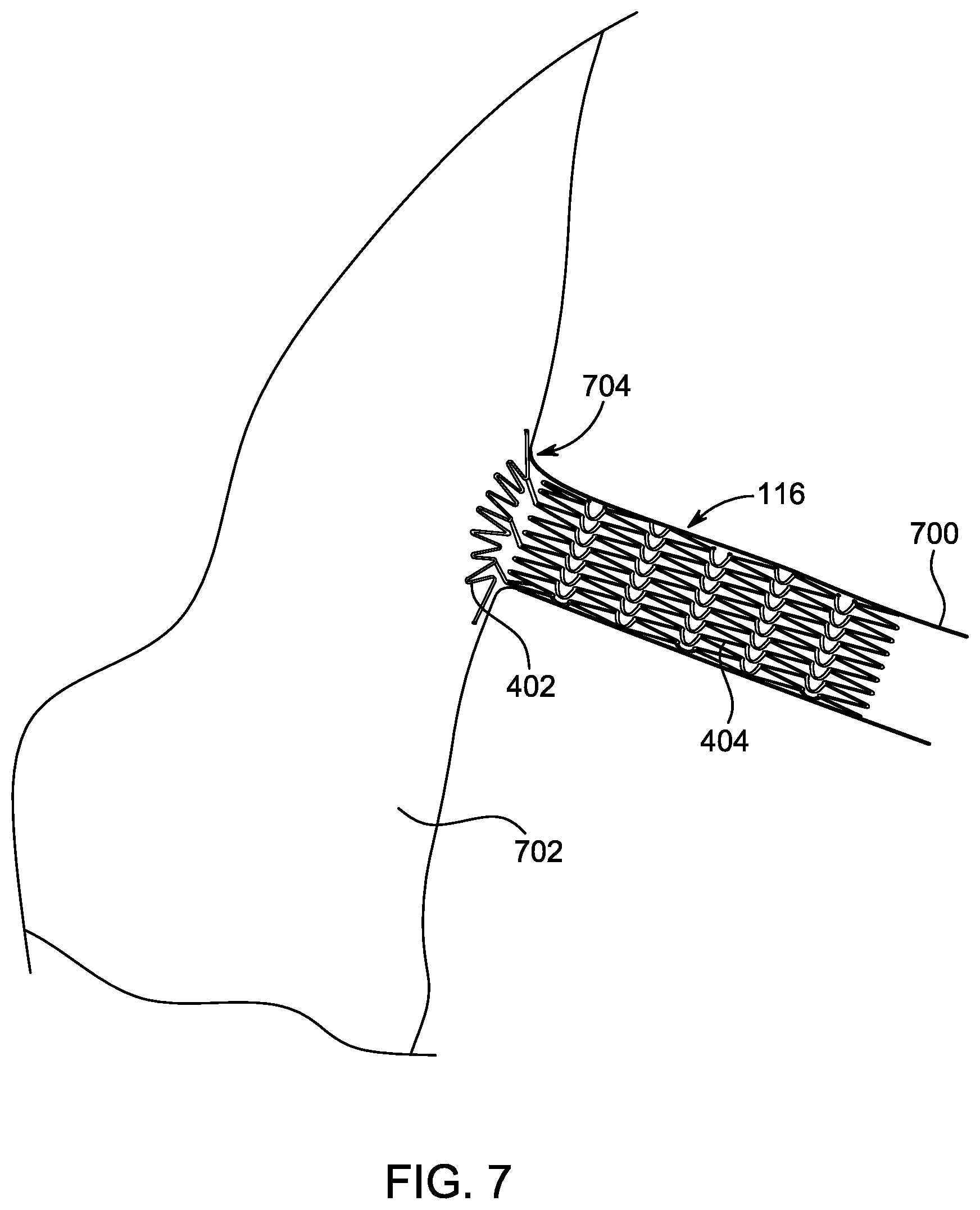 Patent US12496203 Figure 8 – Ostial stenting under vision