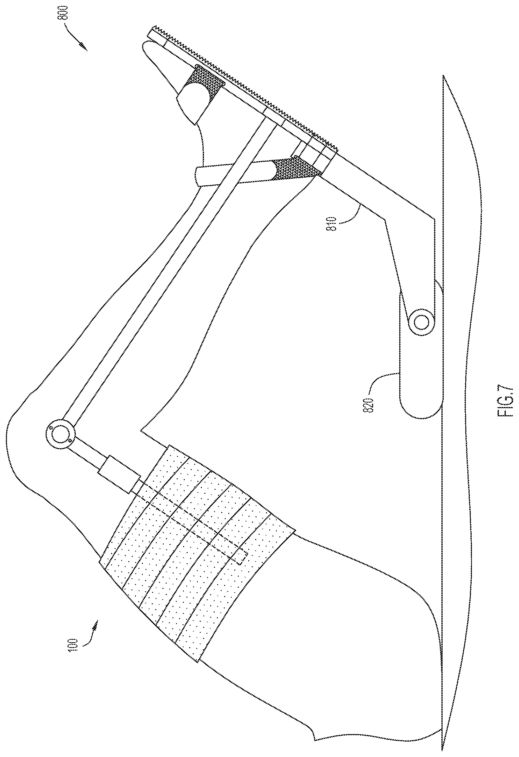 Patent US12496210 Figure 7 – Method and apparatus to maintain distance between bones of a neck for pain relief
